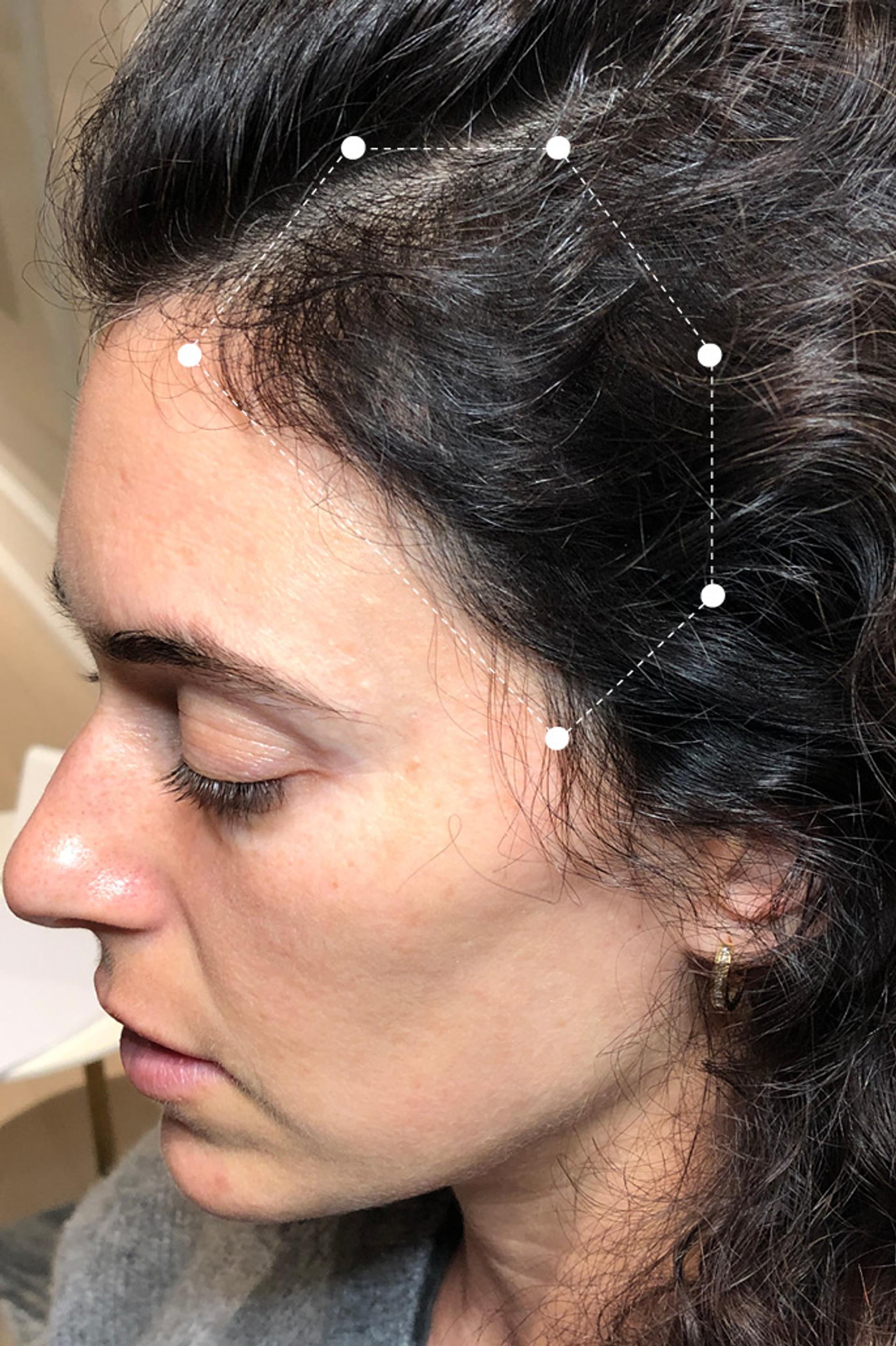Close Up Picture of Hair Thinning around the Temple area on Dark Haired Client After using Harklinikken Treatment