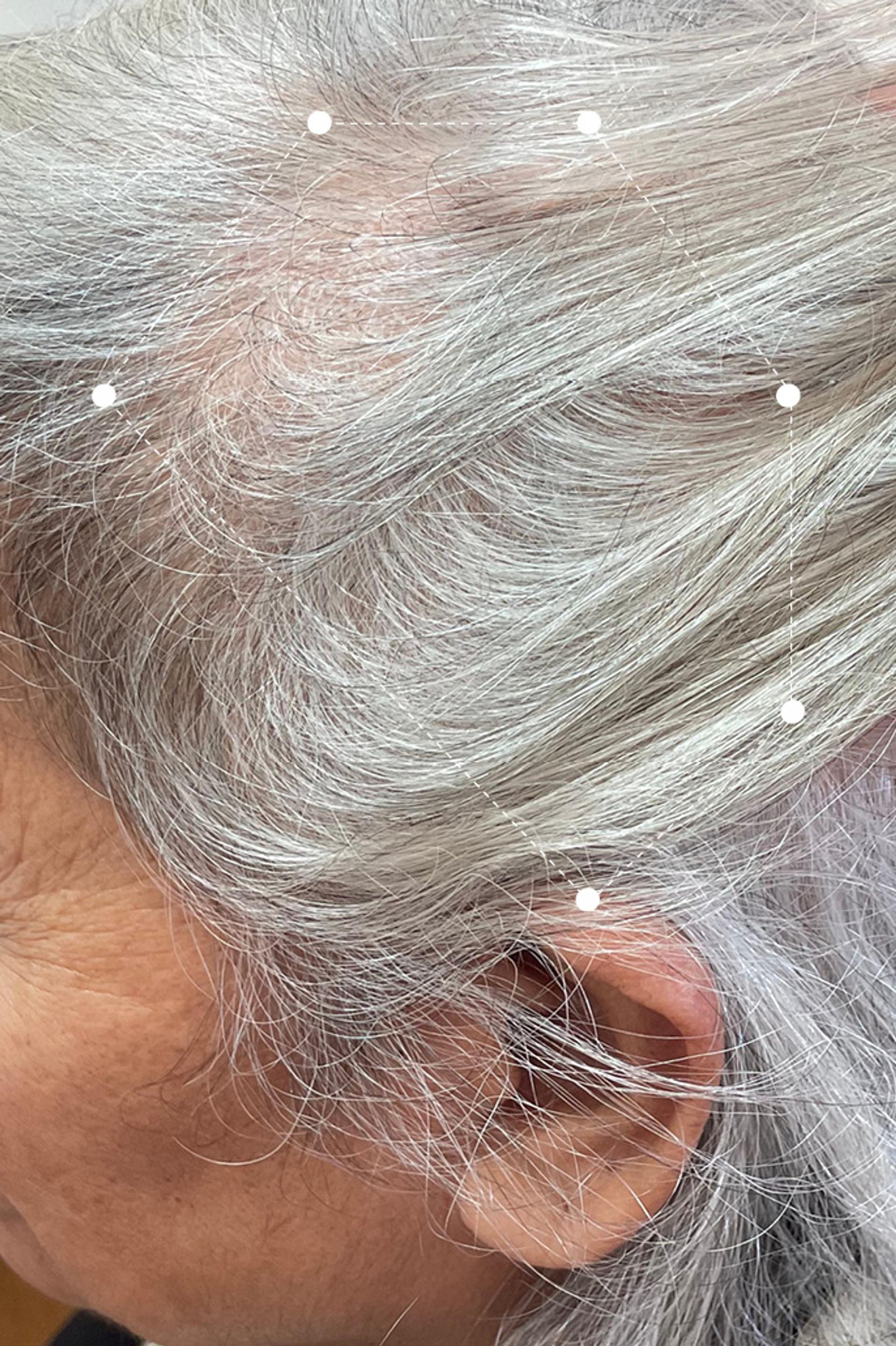 Side of head very close up of grey haired over 60s woman's hair and scalp after 10 months on the Harklinikken Regimen