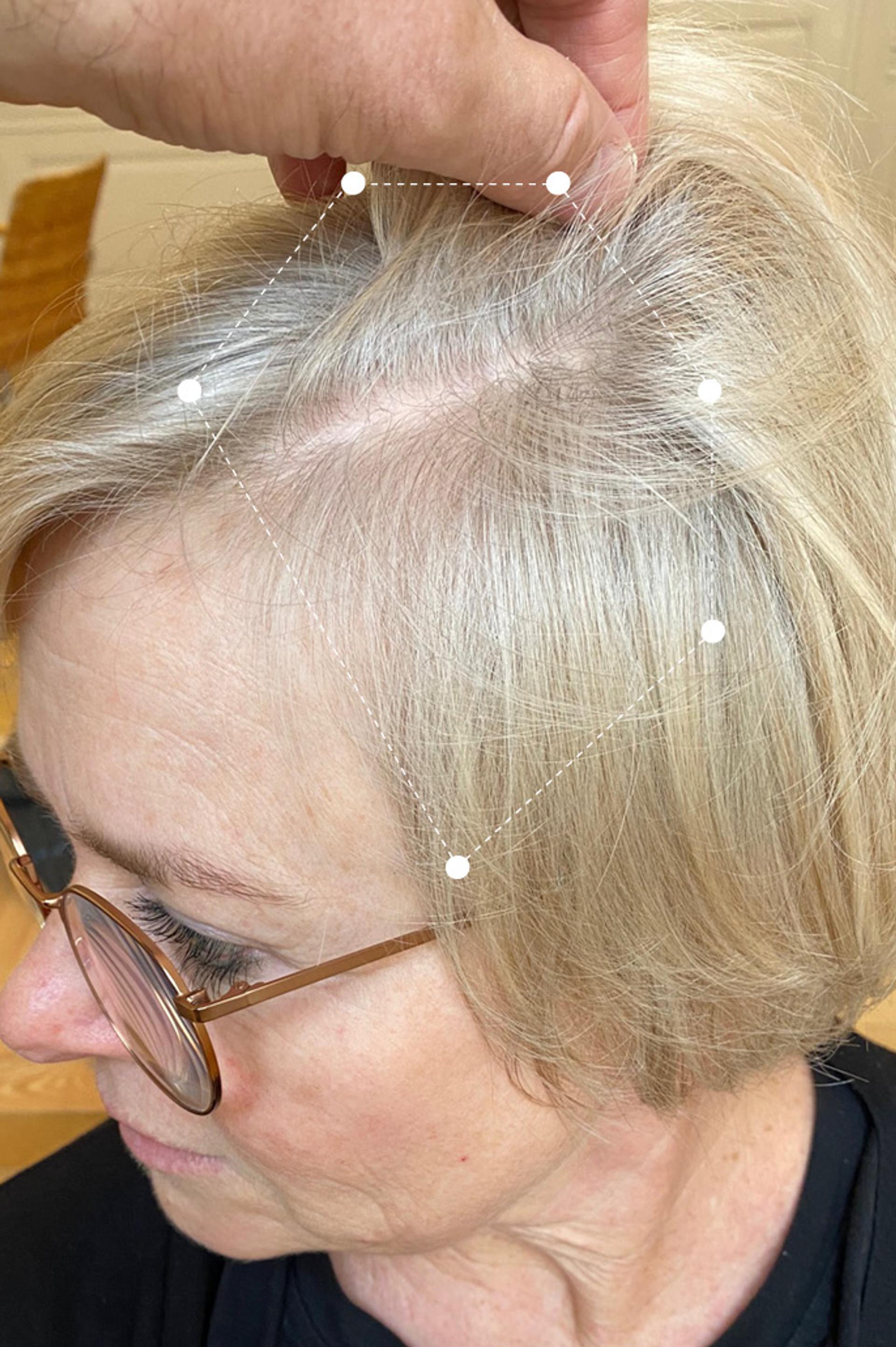 Top Side of head close up of gray haired woman's full hairline scalp after 9 months on the Harklinikken Regimen