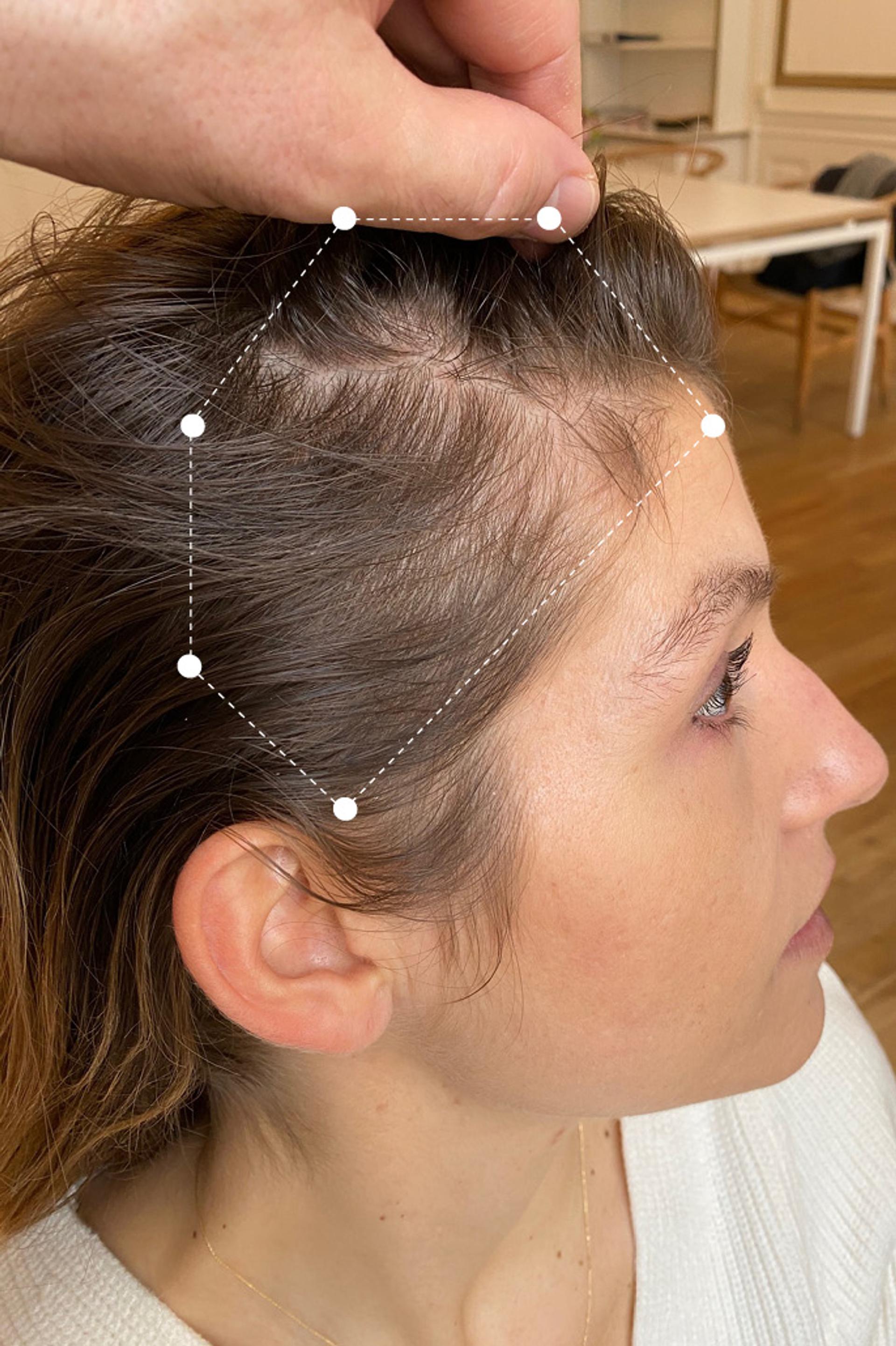 Right side of head close up photo of brunette female scalp 11 months before Harklinikken Regimen