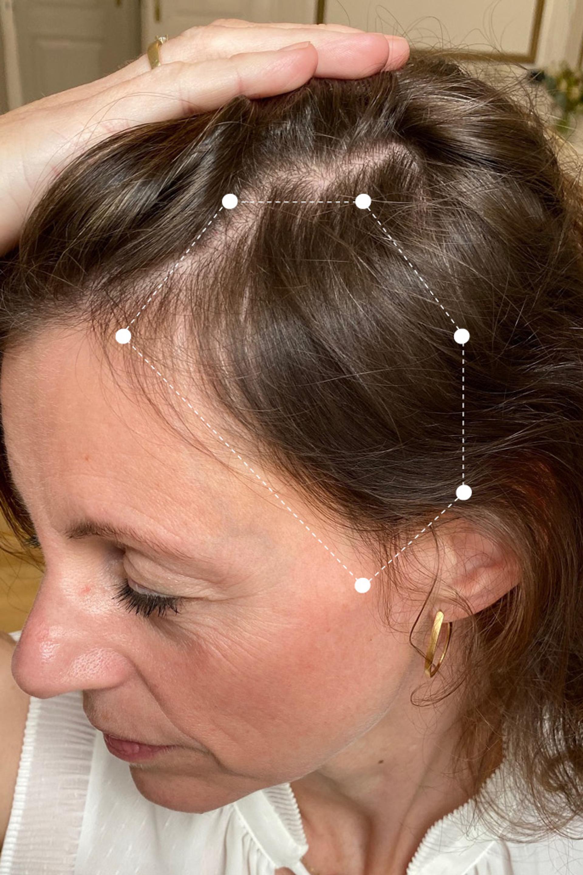 Scalp Hair Thinning around Temple area on Brunette Client After using the Harklinikken Regimen