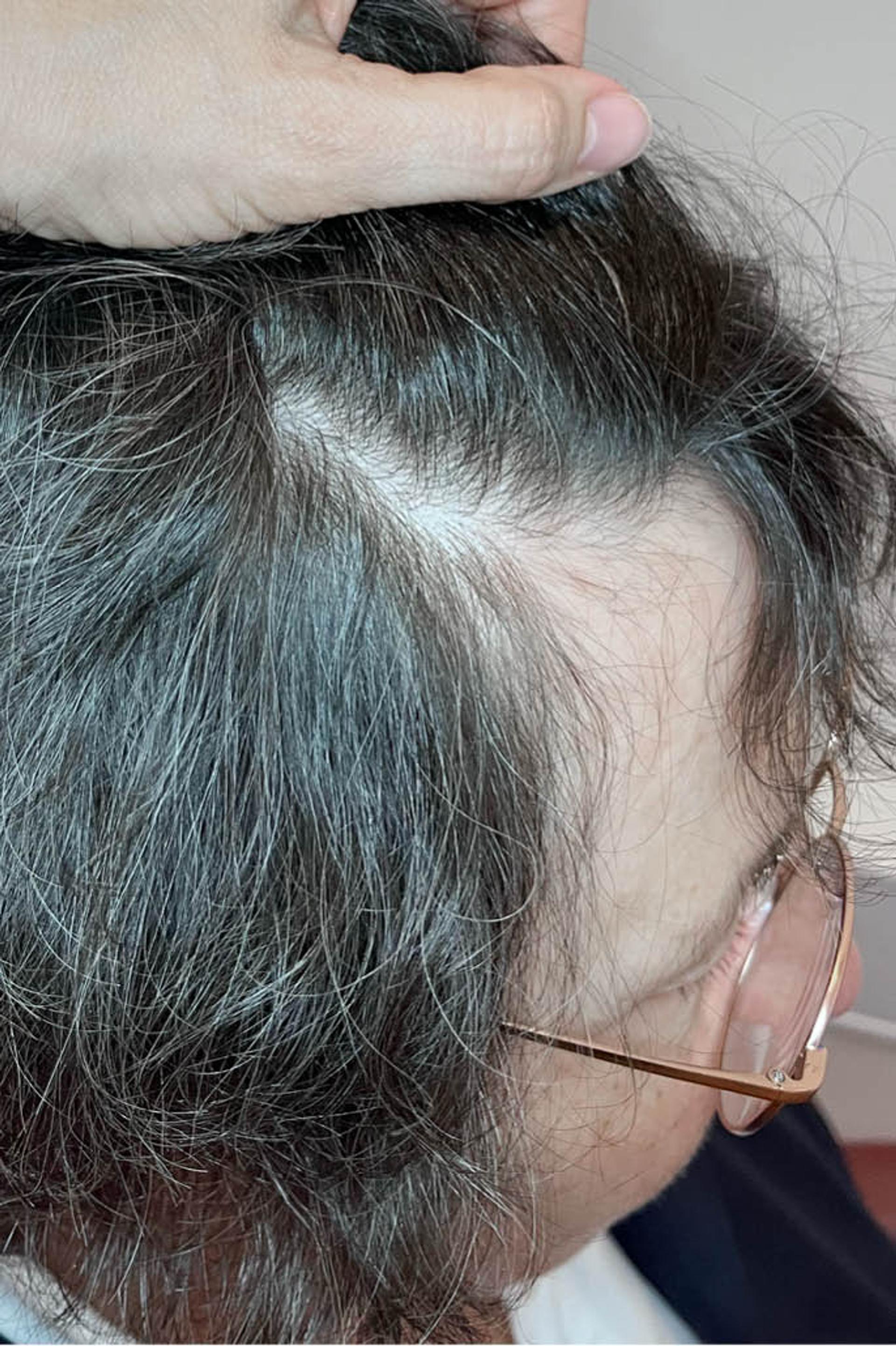 Side view of a female's temple area in her 60s with dark wavy hair 12 months after using the Harklinikken Extract
