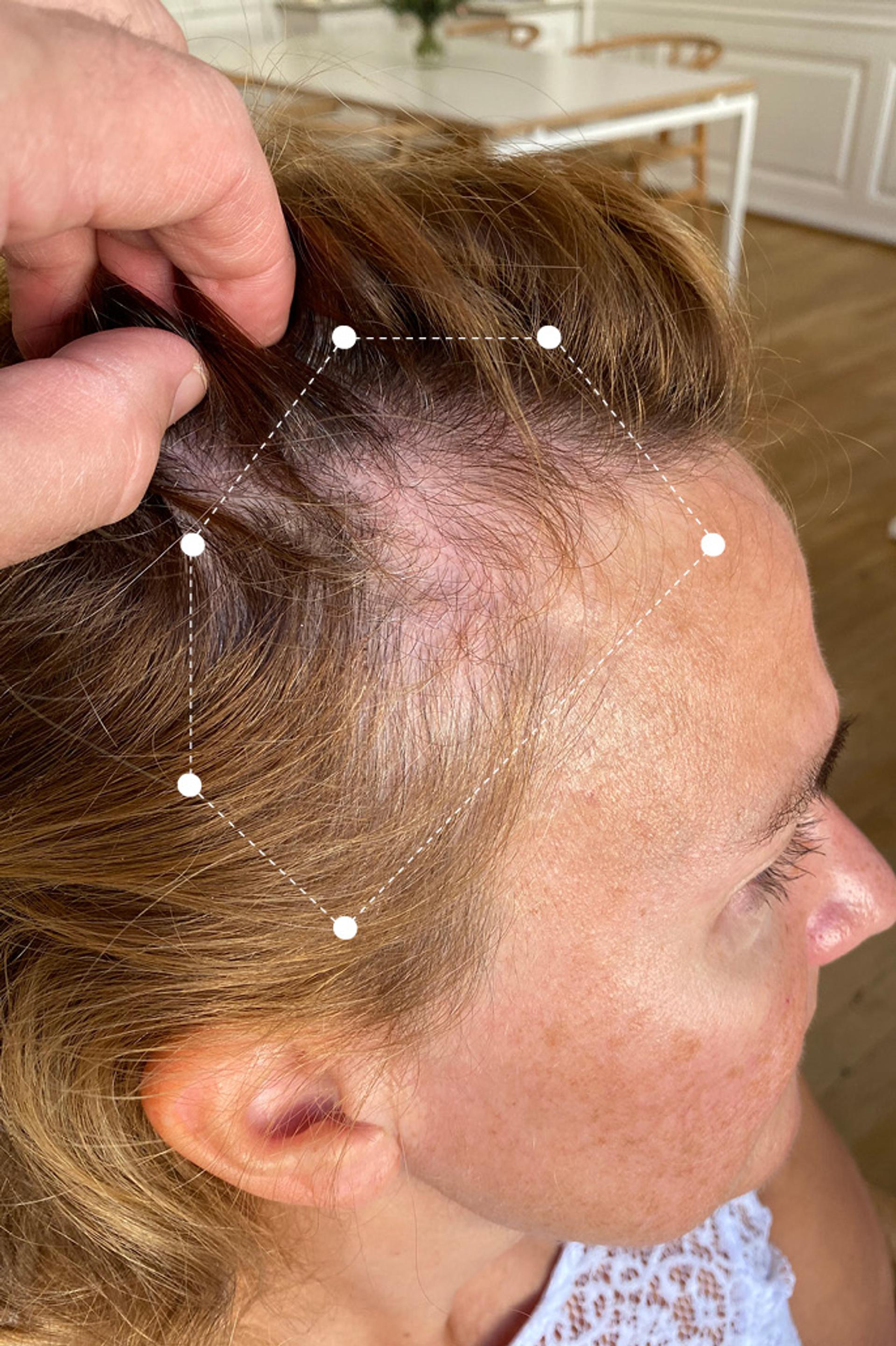 Temple Side of Head  Hair Thinning on Red Head Female Client before using the Harklinikken Extract for 19 months