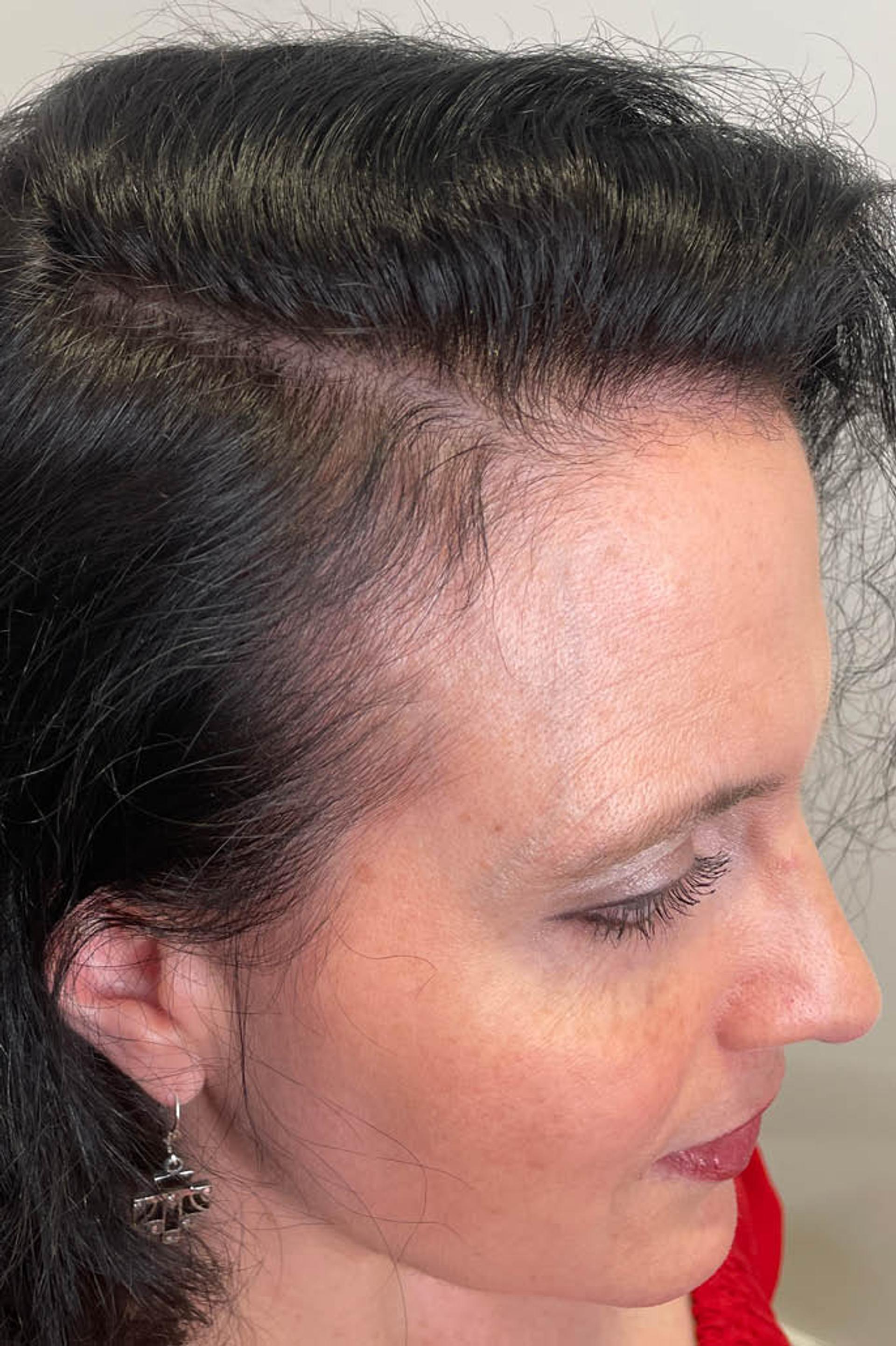 After hair and scalp photo of a dark haired female women in her 40s facing towards the right