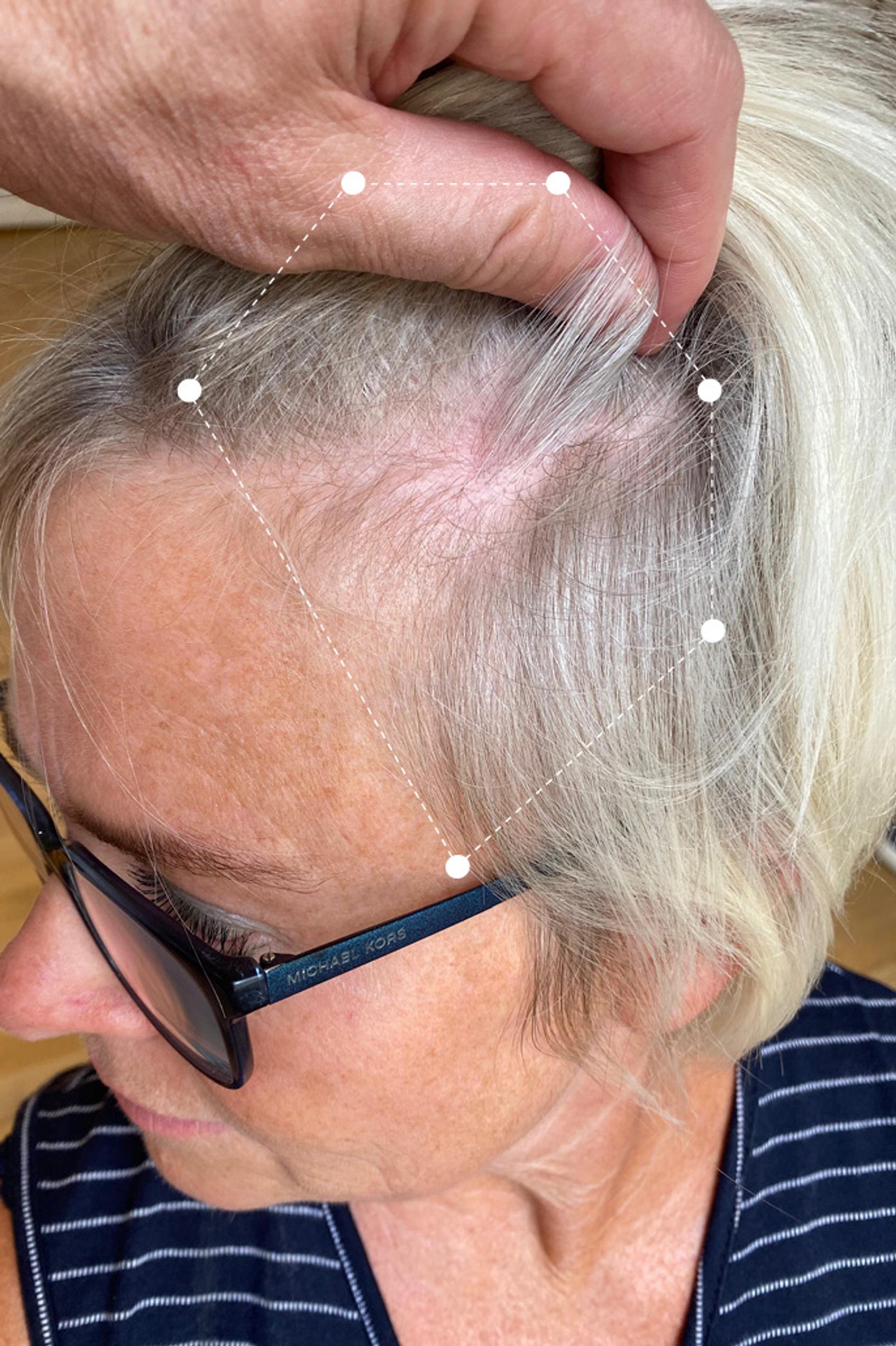 Side of head close up of gray haired woman's scalp before going on the Harklinikken Regimen