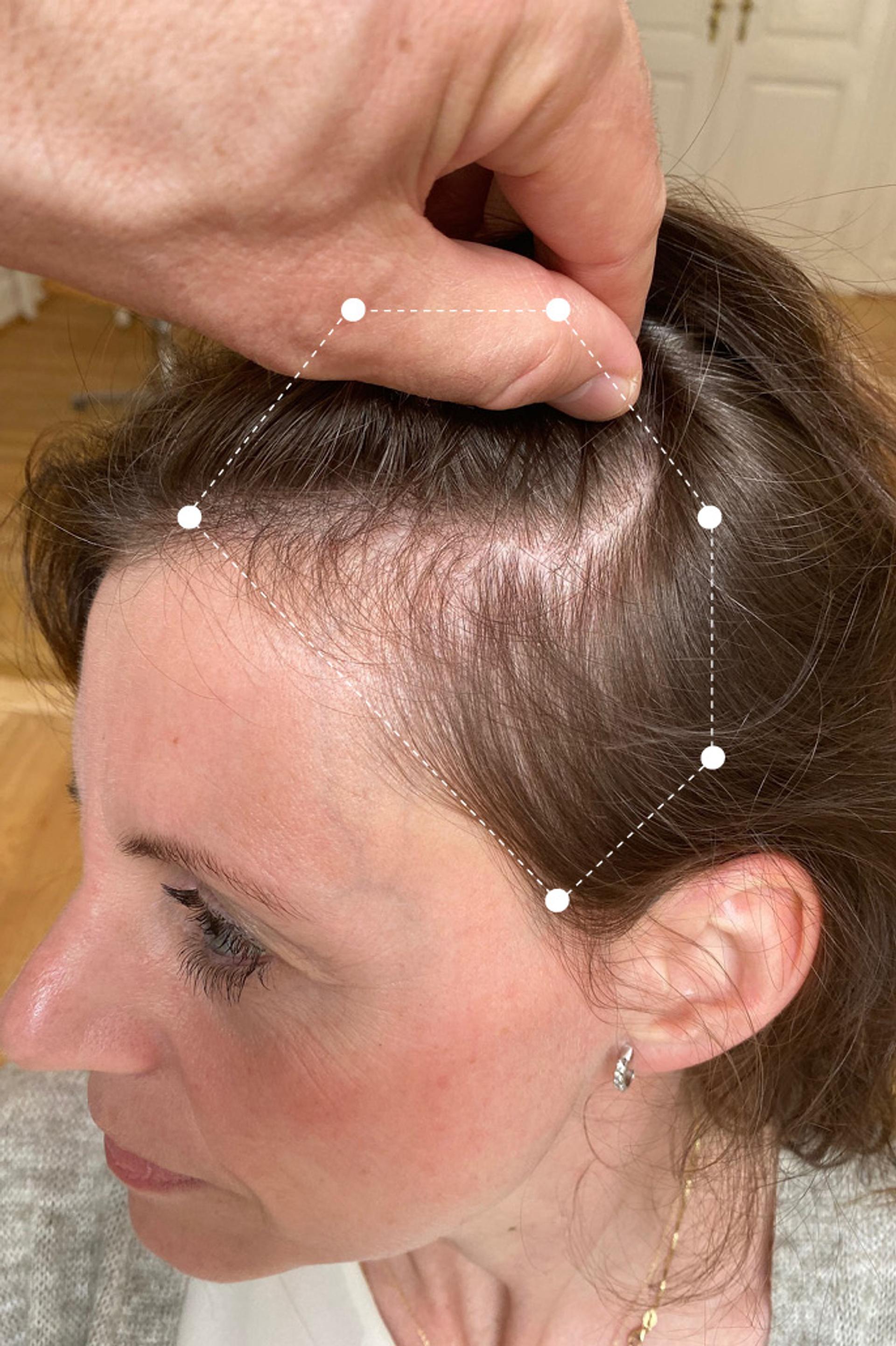 Scalp Hair Thinning around Temple area on Brunette Client Before using the Harklinikken Regimen