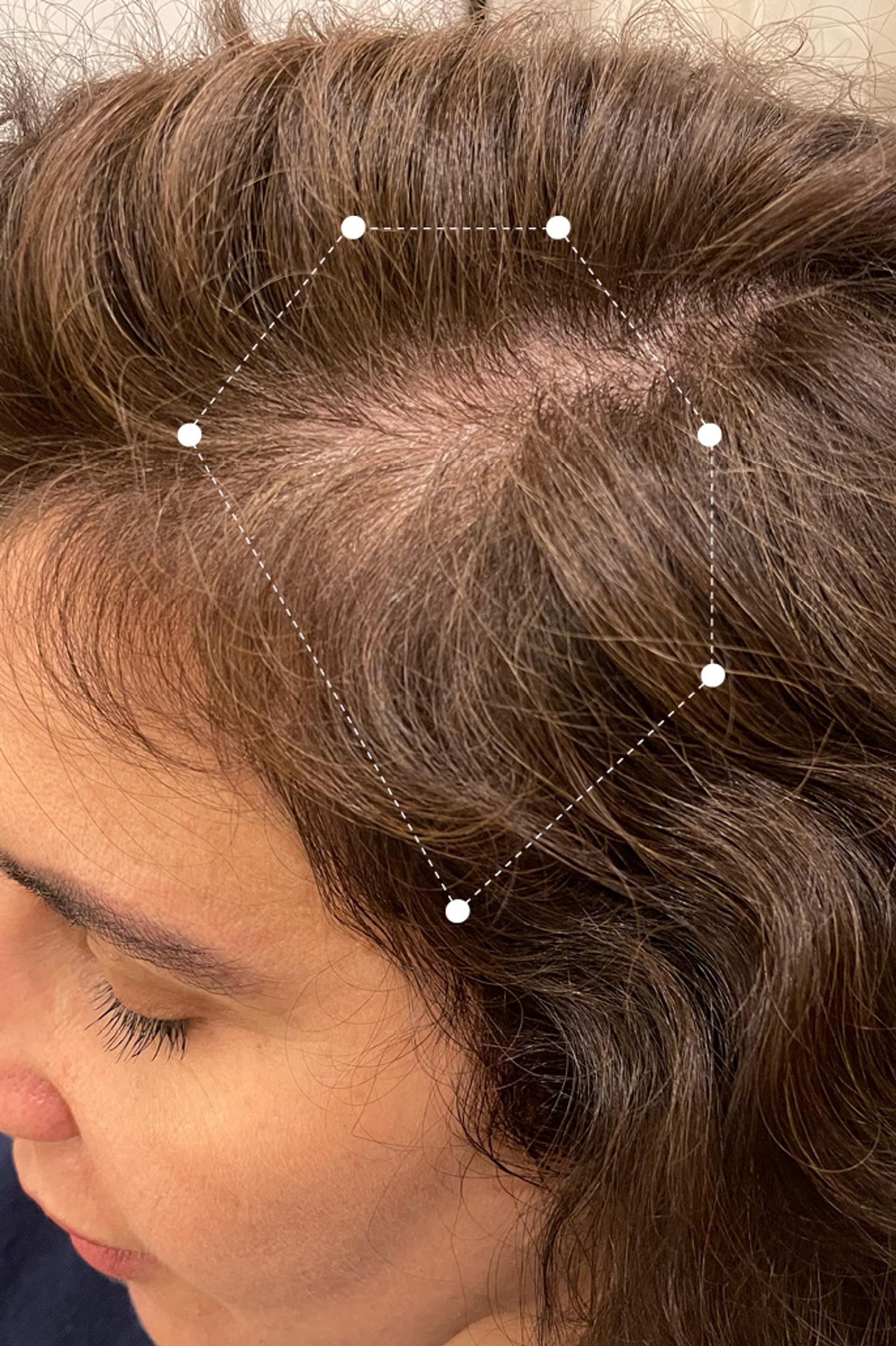 Side of head close up of brown haired woman's full scalp after 30 months on the Harklinikken Regimen