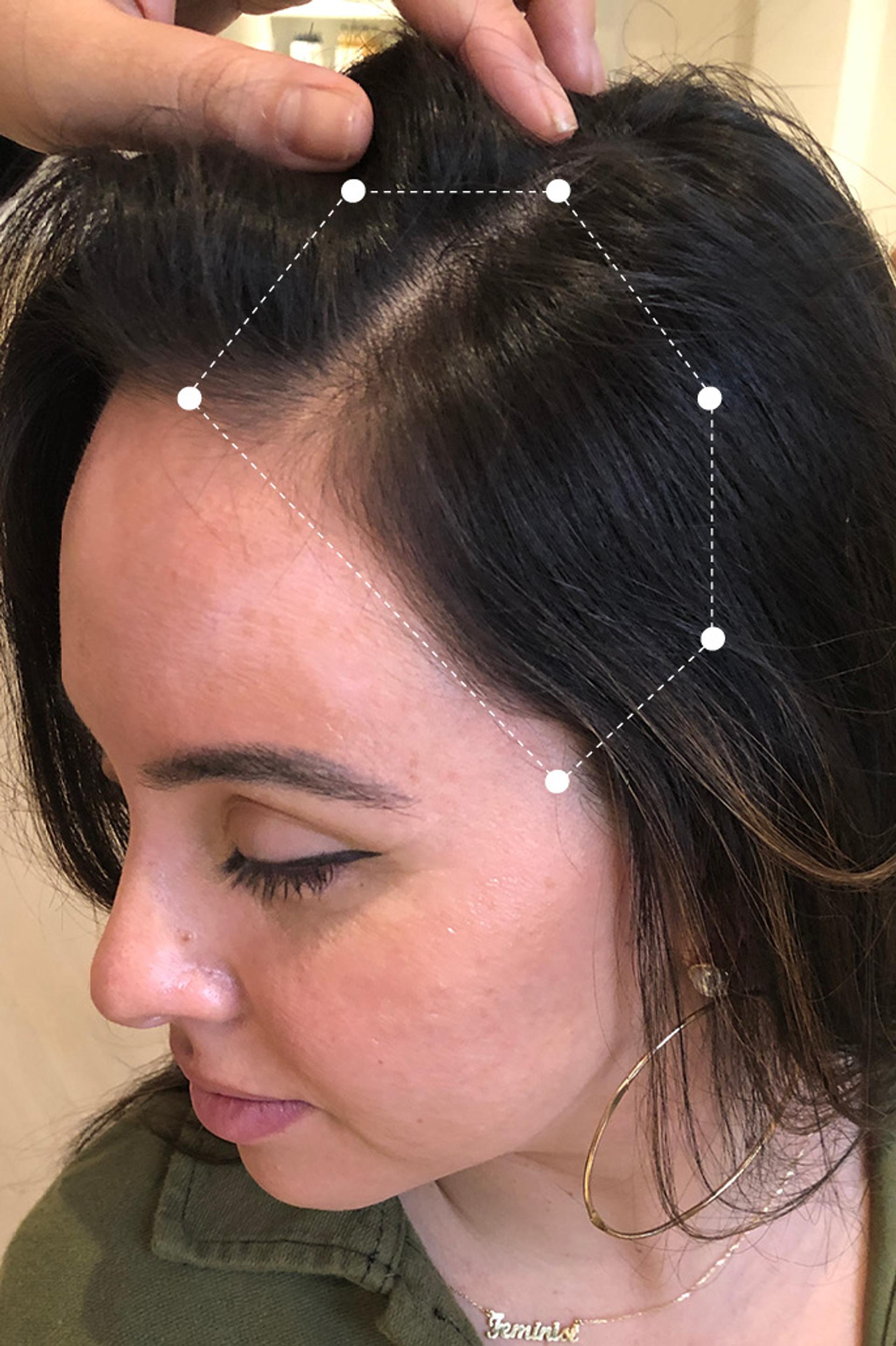 Top Side of head close up of dark haired woman's scalp 4 months after going on the Harklinikken Regimen