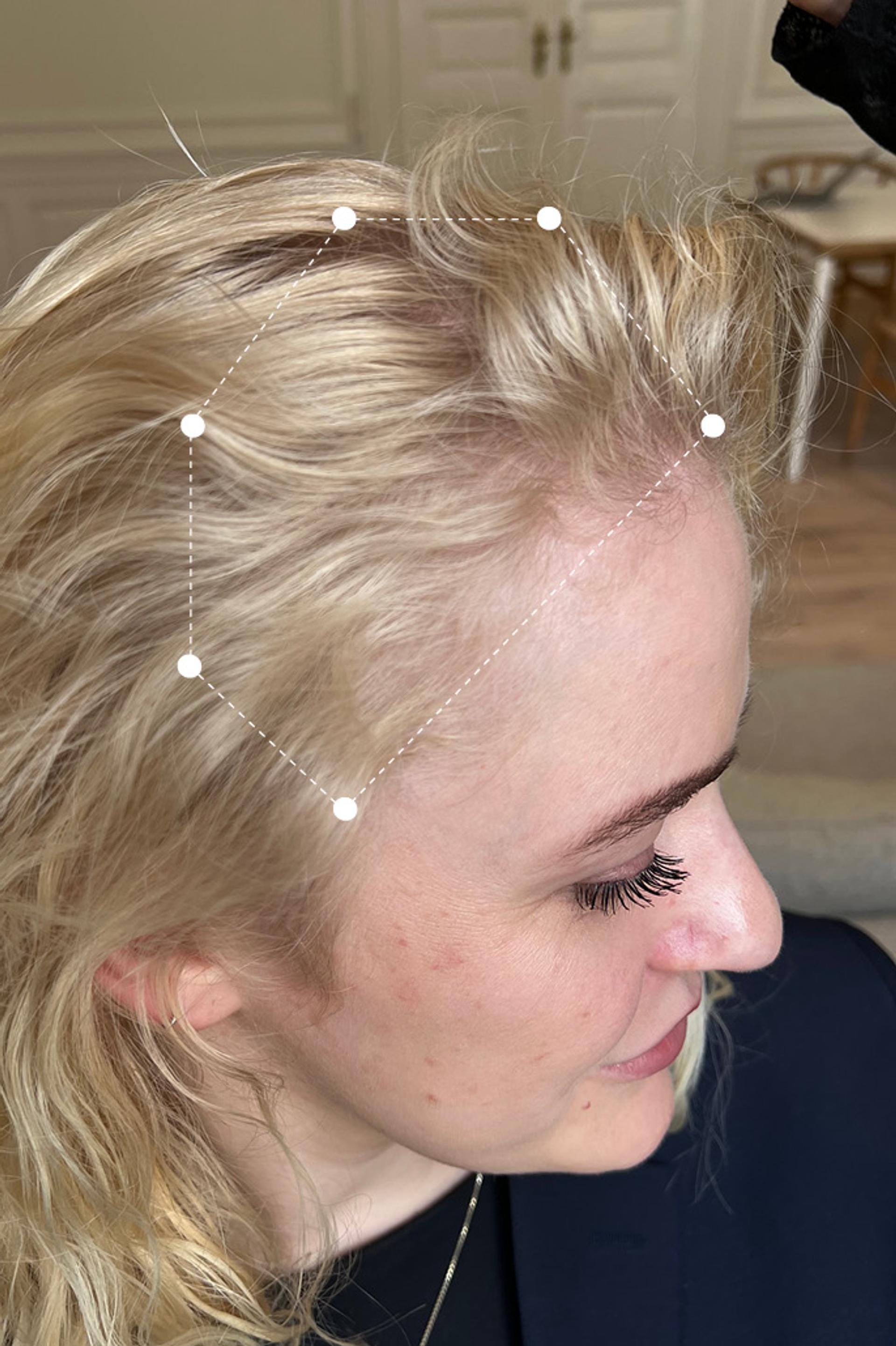 Picture of Hair and Scalp Temple Thinning 14 Months After Harklinikken Regimen