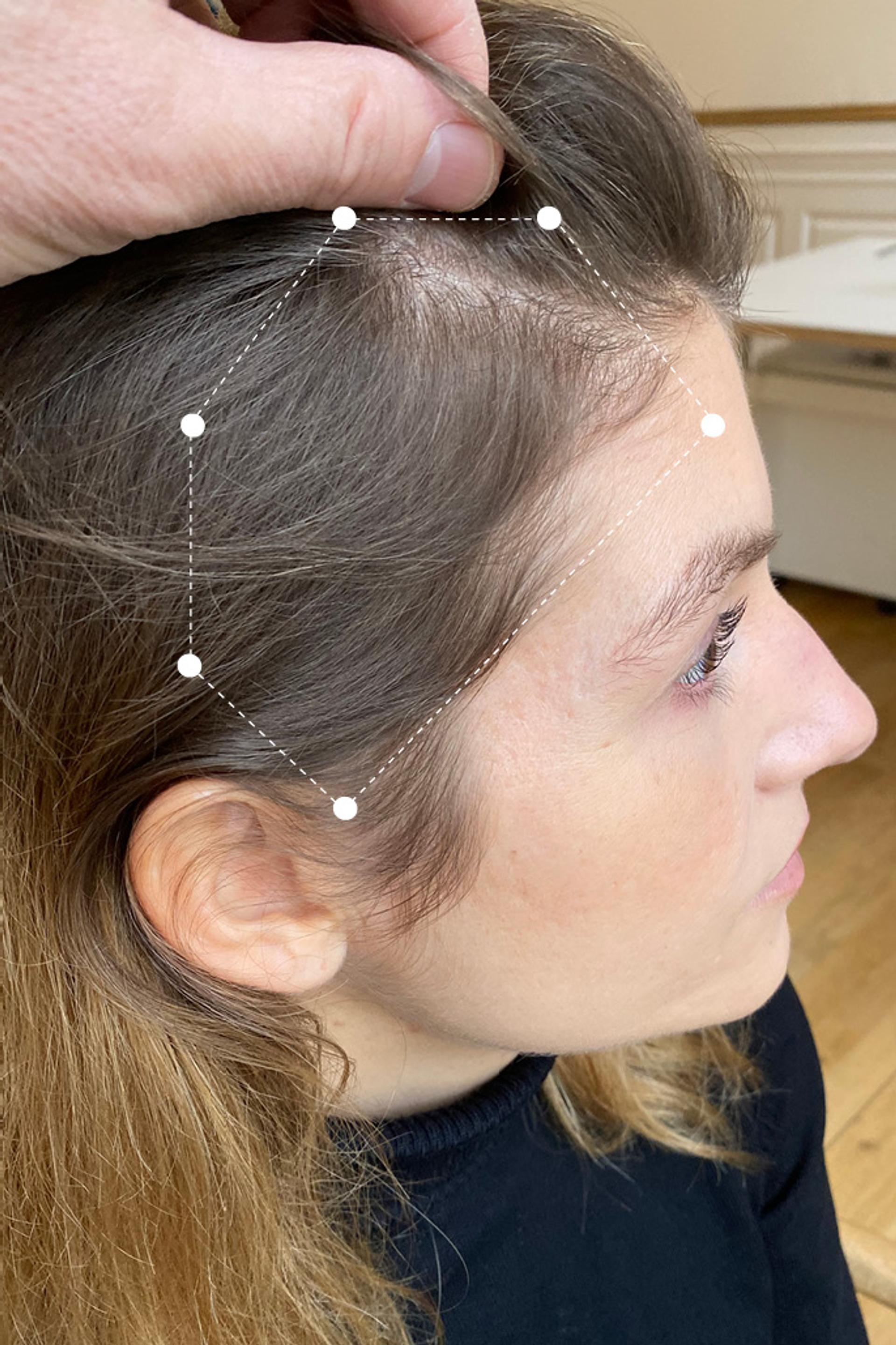 Right side of head close up photo of brunette female scalp 11 months after Harklinikken Regimen