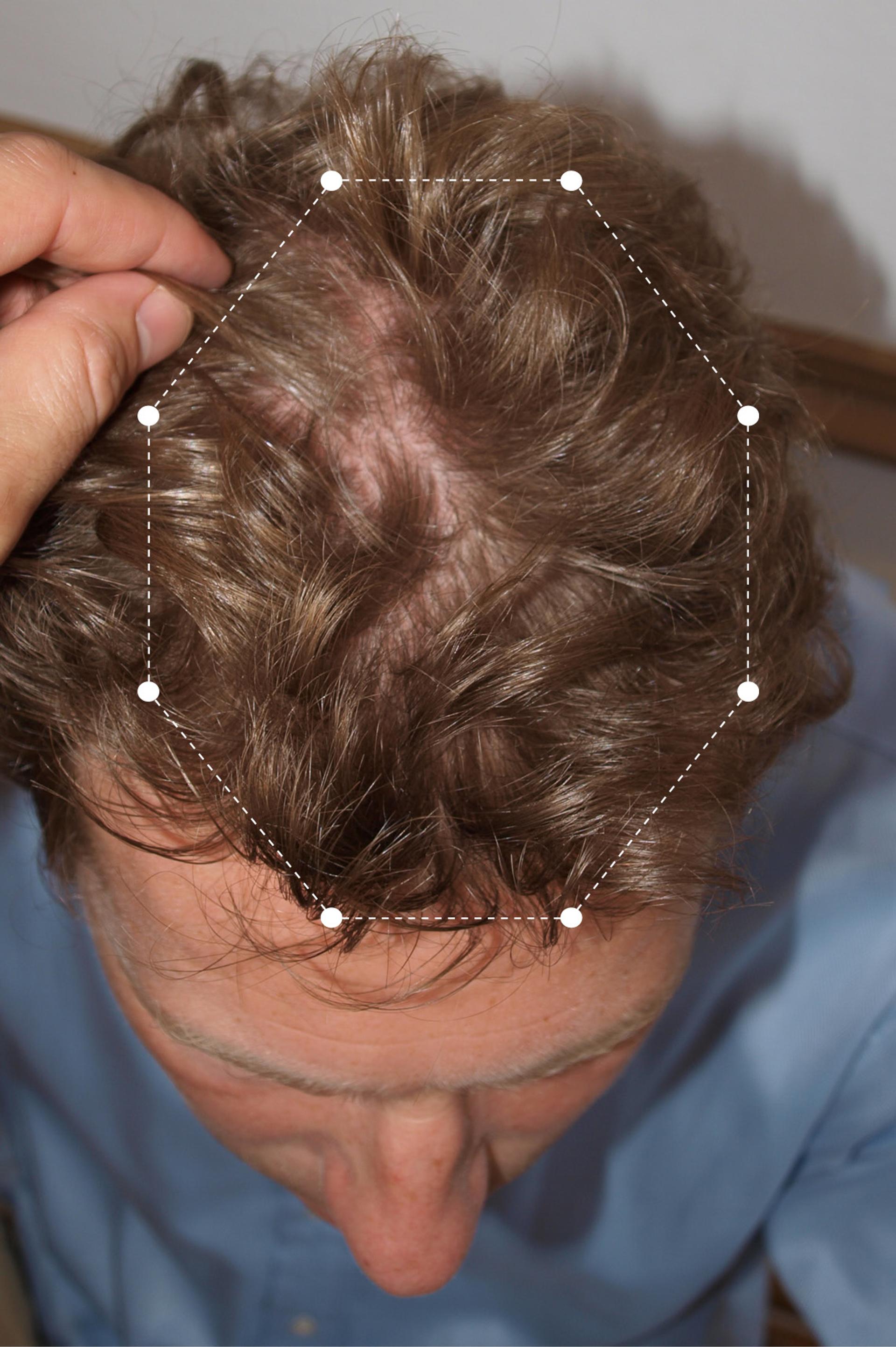 Picture of male's scalp, brunette hair, before using the Harklinikken regime