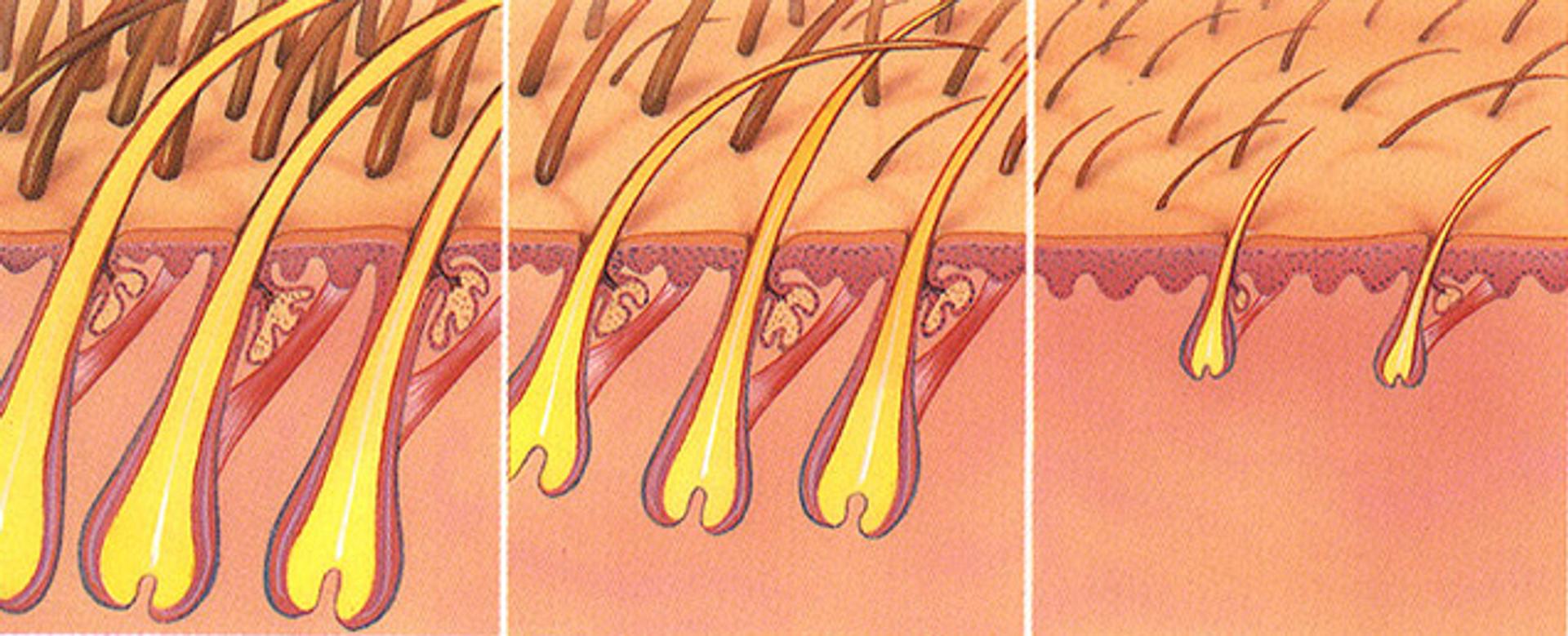 Hair folicles in different states of miniaturization