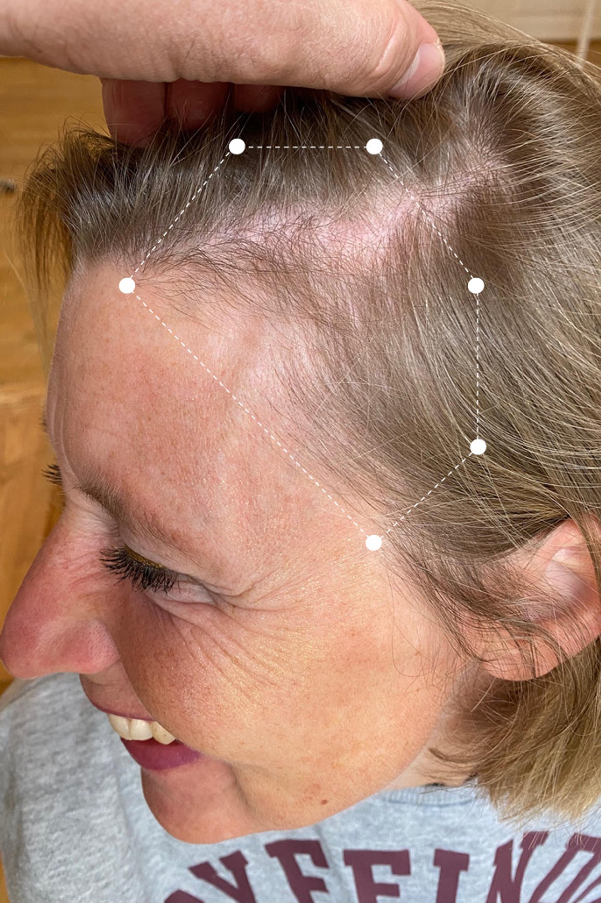 Picture of Hair Thinning around Temple Area on Dark Blonde Client Before using the Harklinikken Hair Gain Extract