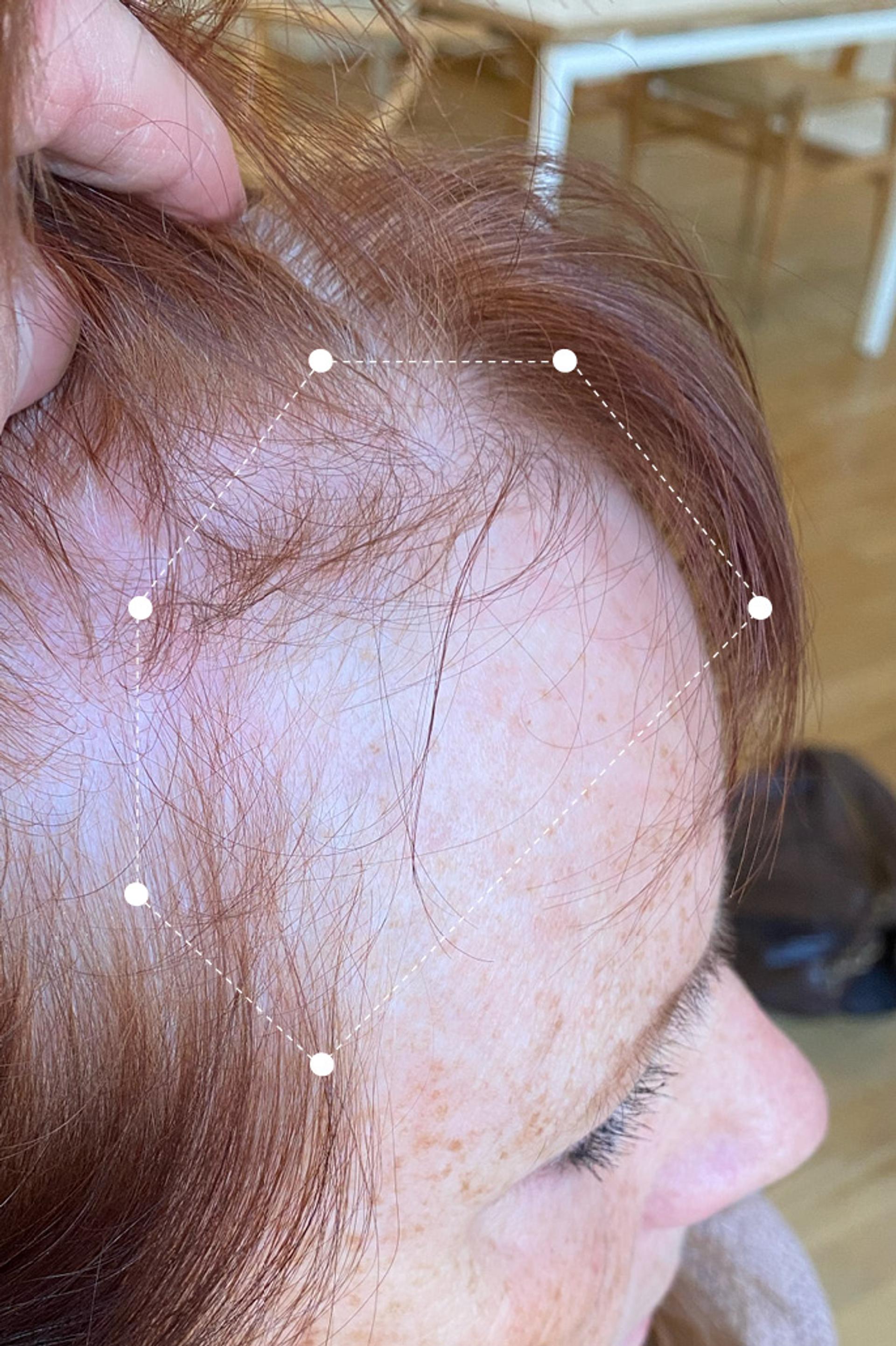 Picture of Hair and Scalp Temple Thinning Before using Harklinikken Regimen