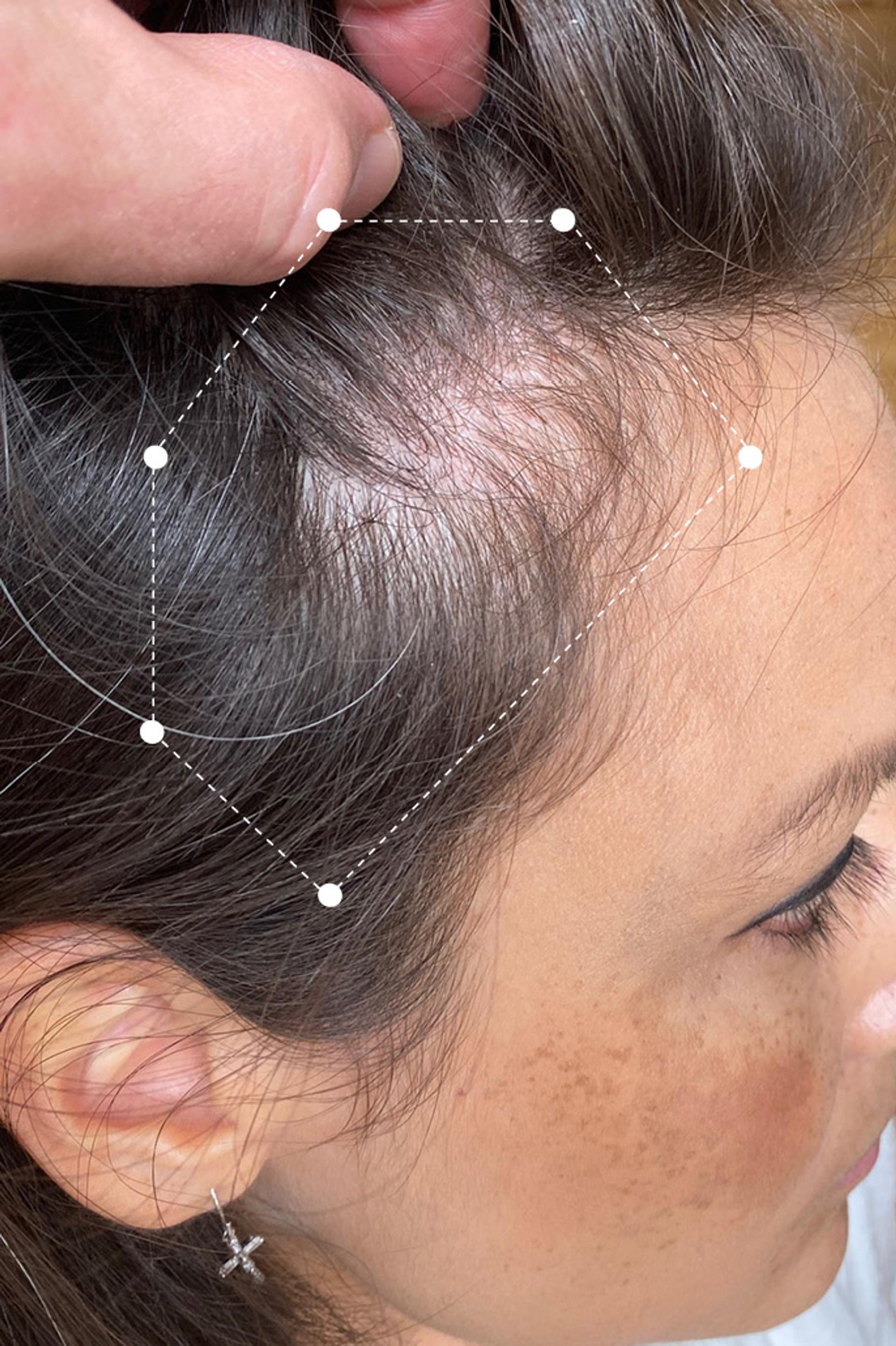 Picture of Scalp and Hair Thinning near Temple Before using the Harklinikken Regimen for 23 months