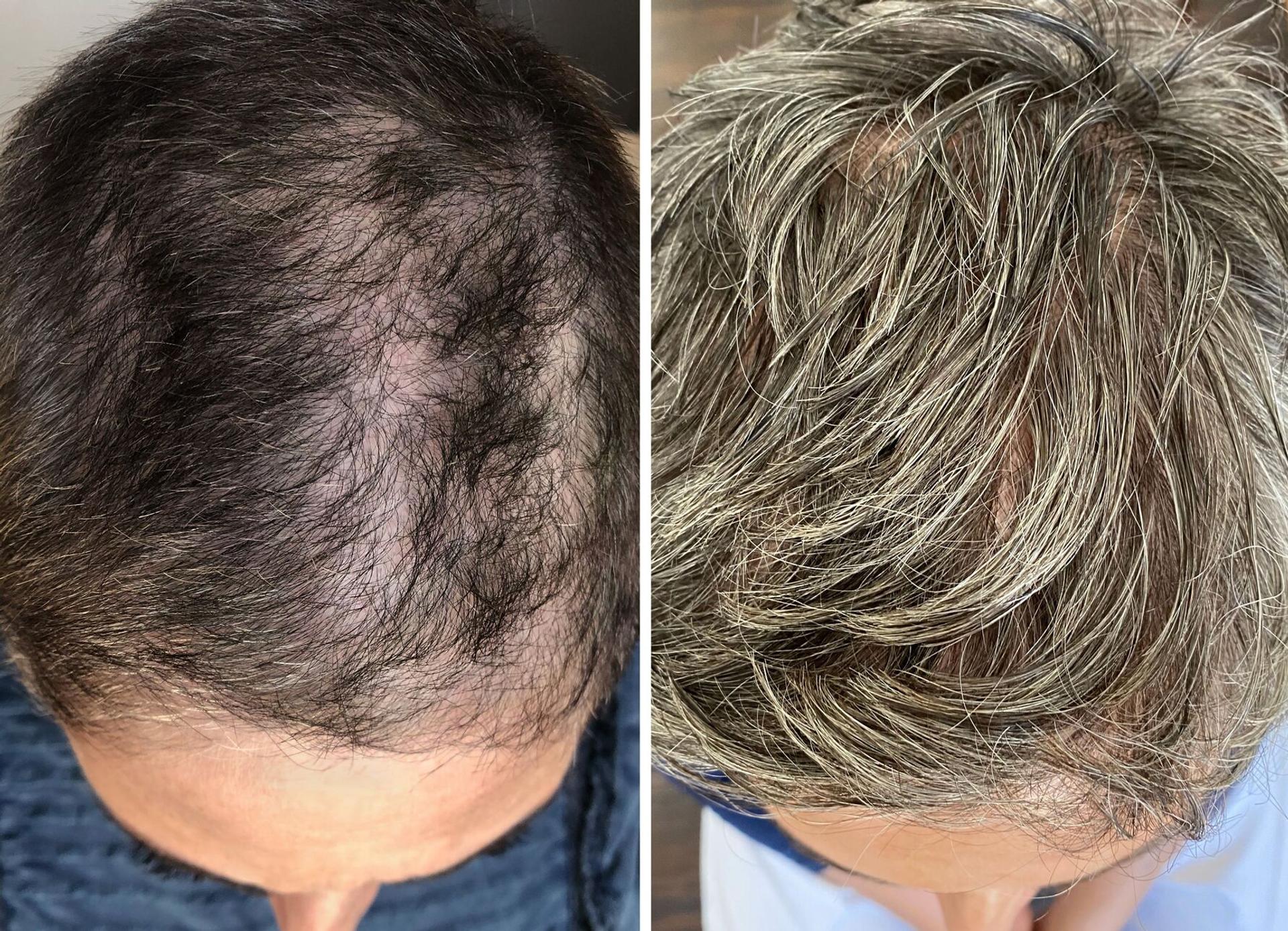 Harklinikken top down before using the extract and after using extract split photo shot of Ricki Lake's scalp and hair