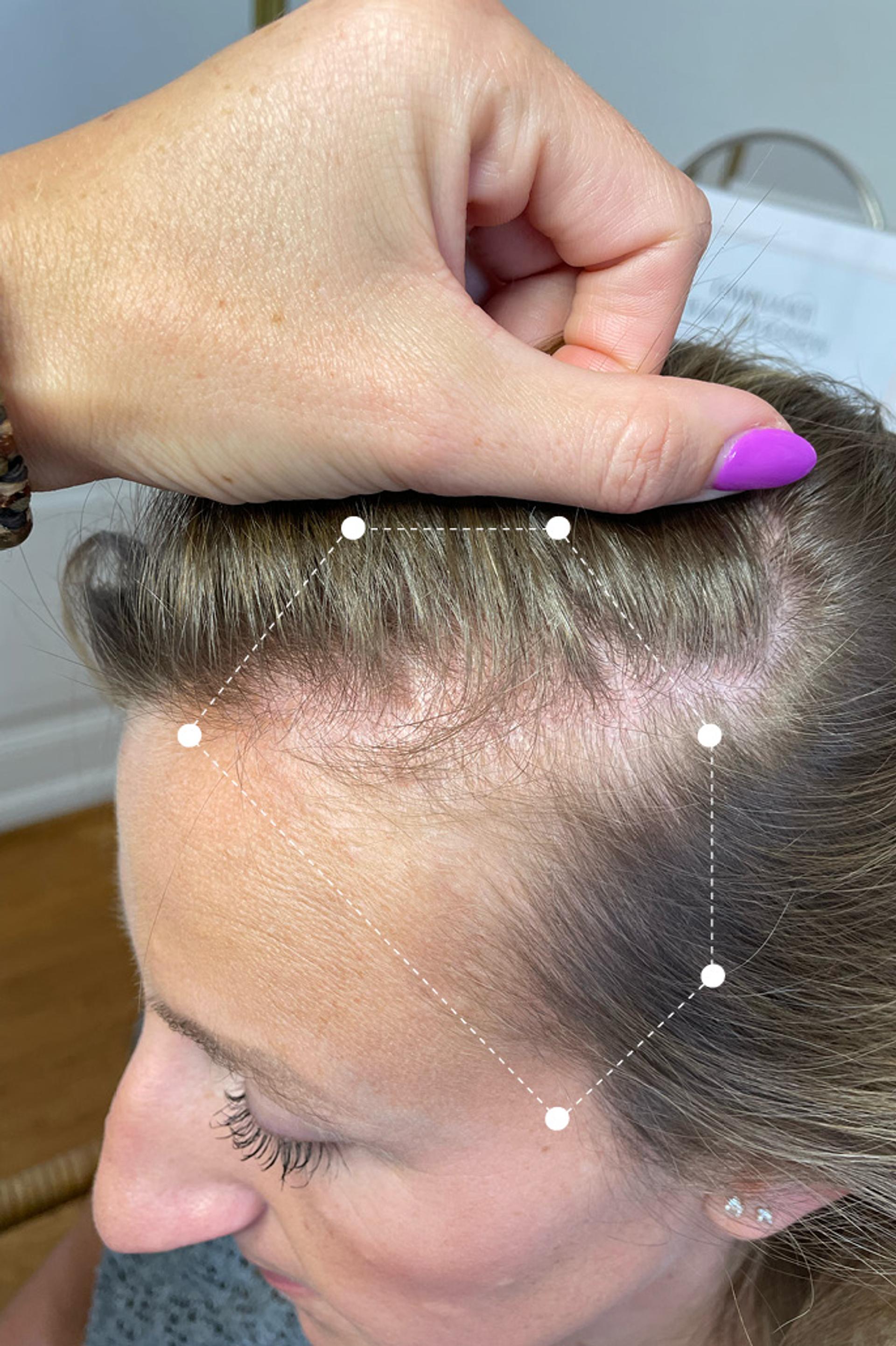 Picture of Temple Hair Thinning on Female Client before using the Harklinikken Extract for 6 months