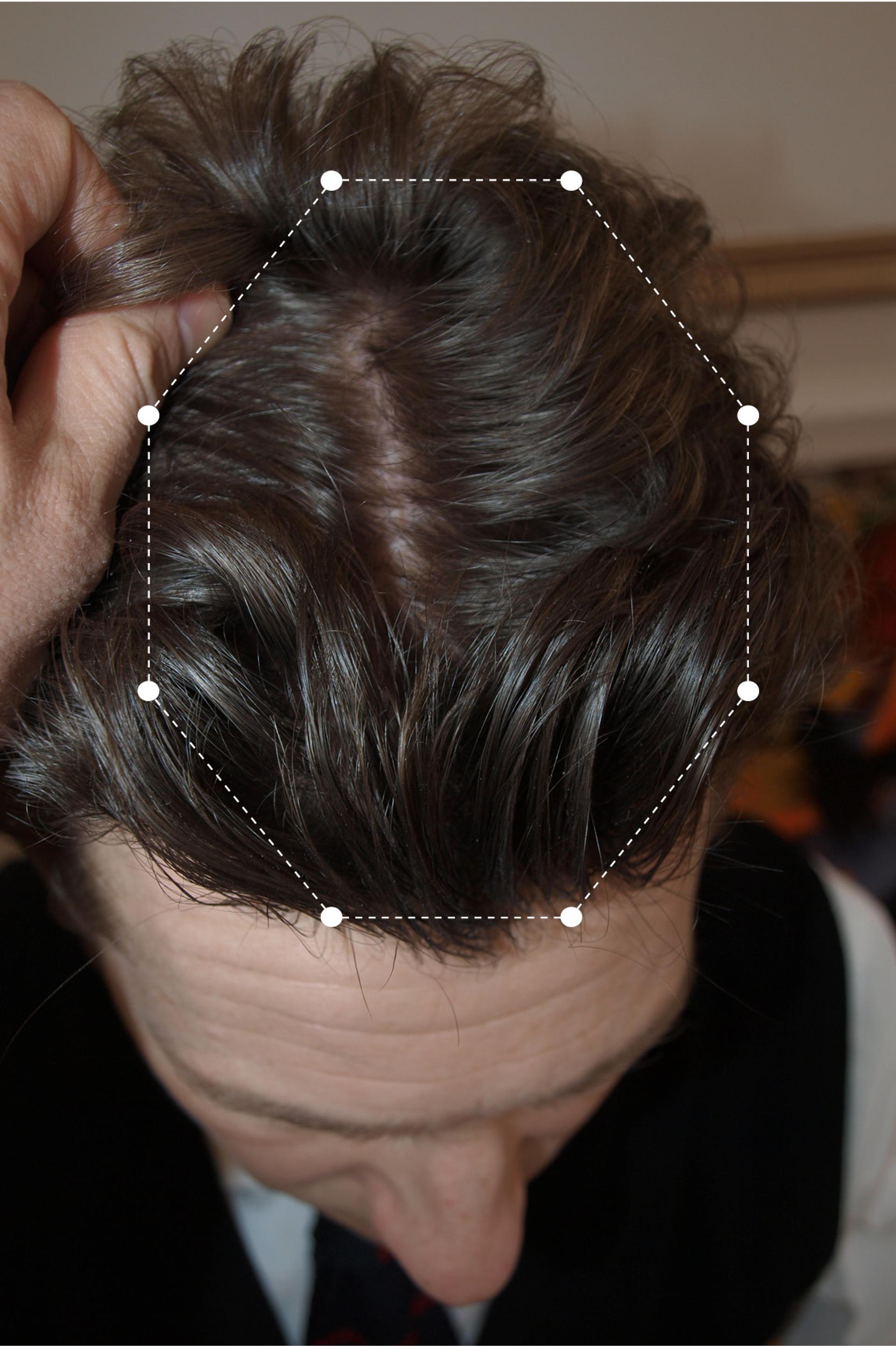Picture of brunette male's scalp and hair line after using the Harklinikken regime for 9 months