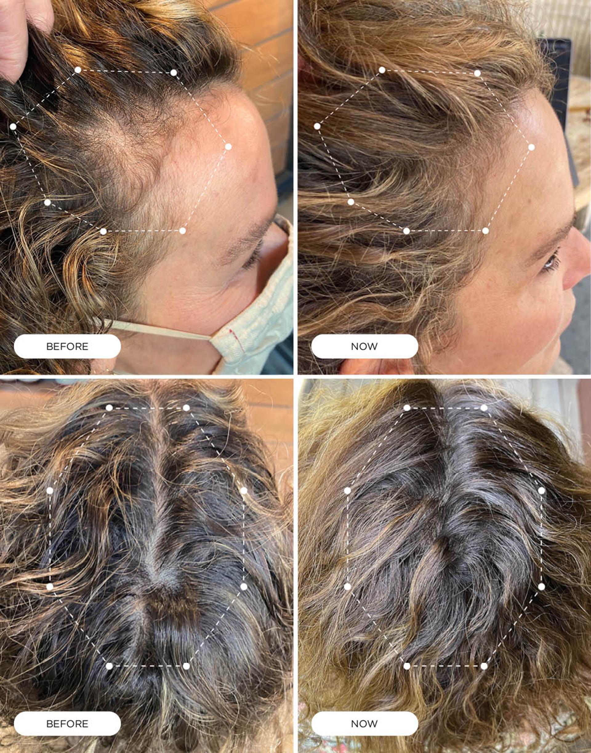 4 photos split into Before & After shots side and top of head of Jenifer Grey's Harklinikken Results