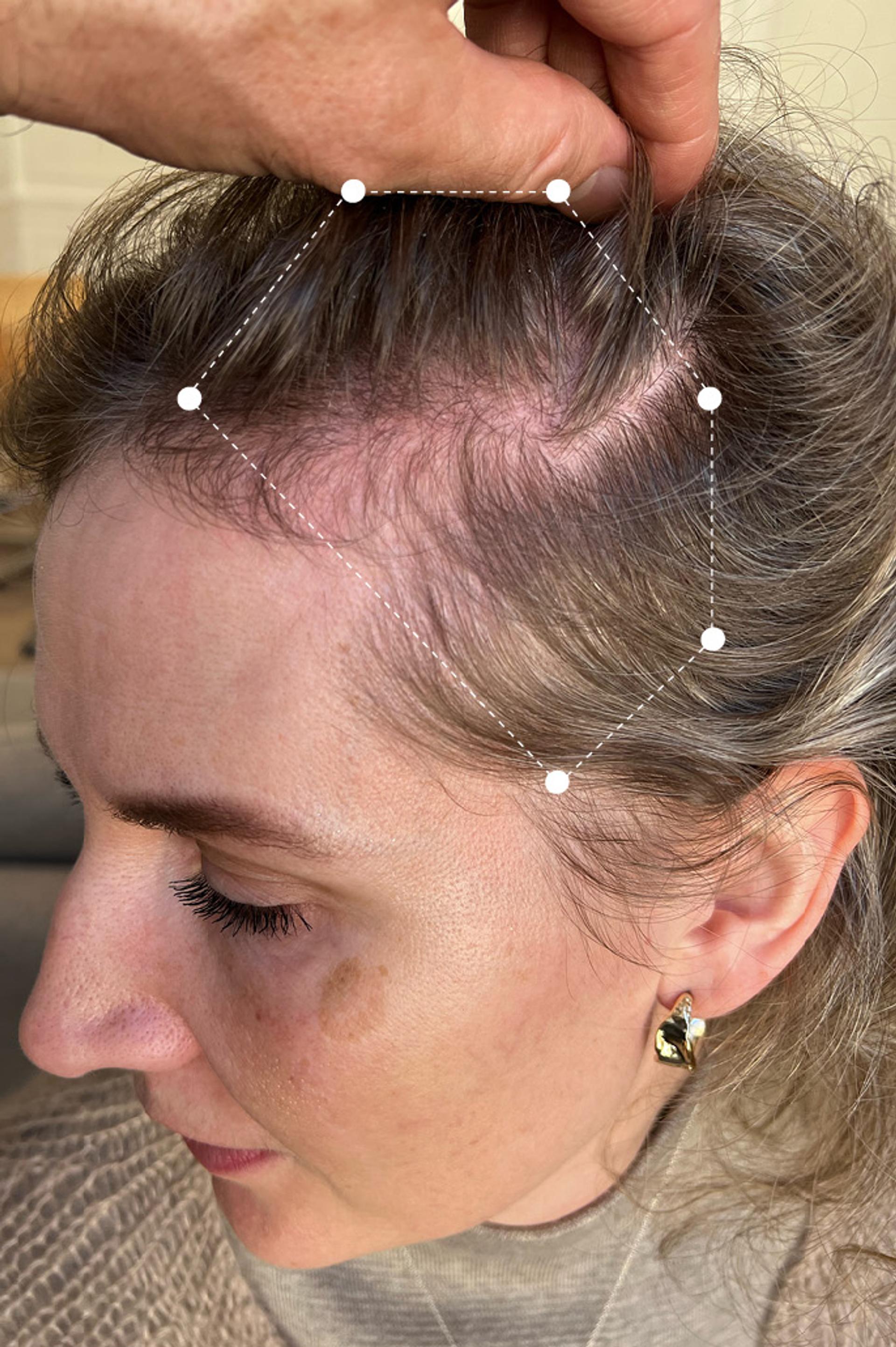 Side of head close up of fair haired woman's full scalp before going on the Harklinikken Regimen