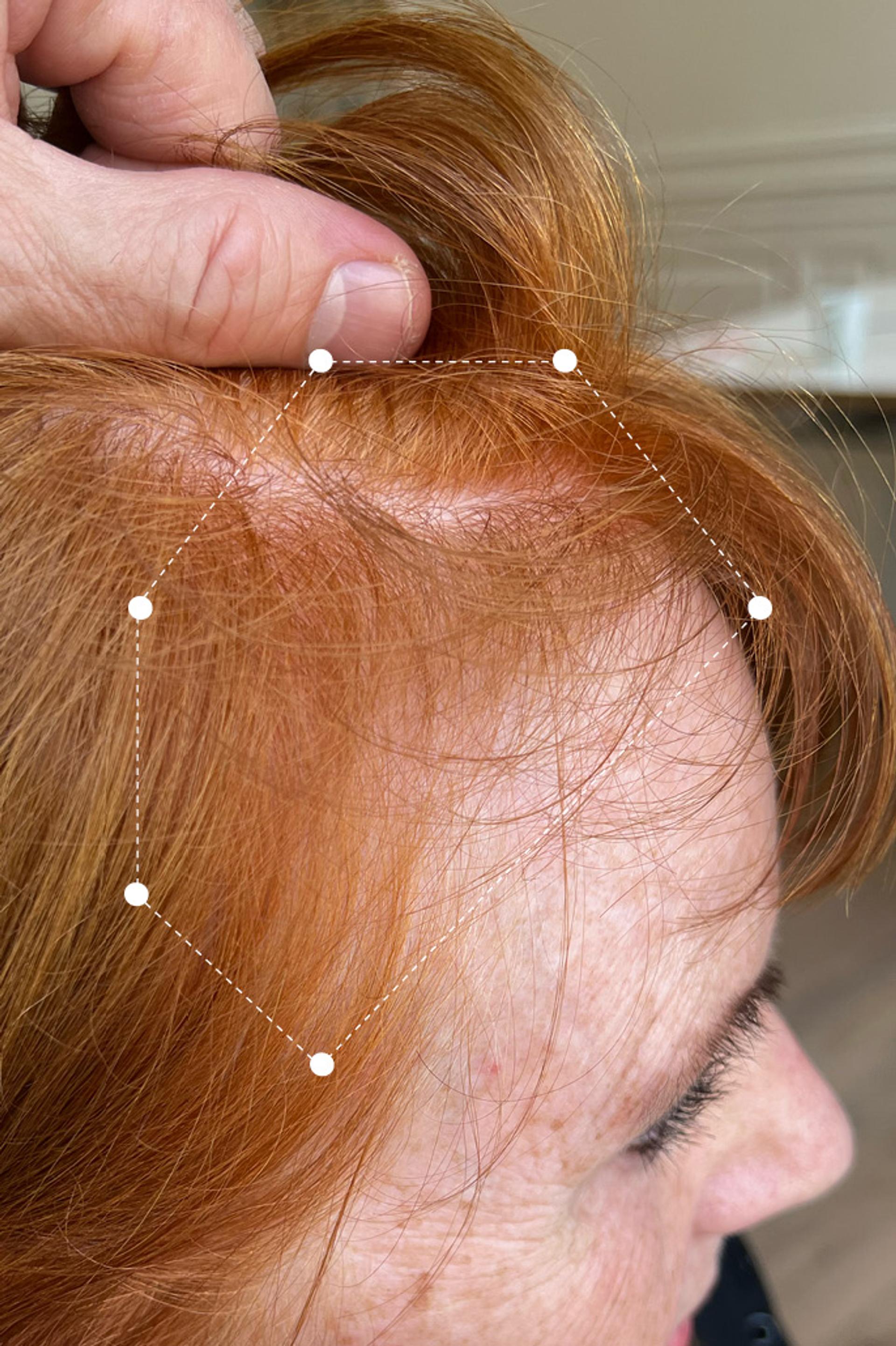 Side of head close up of Light Red Head after 18 months on Harklinikken Regimen