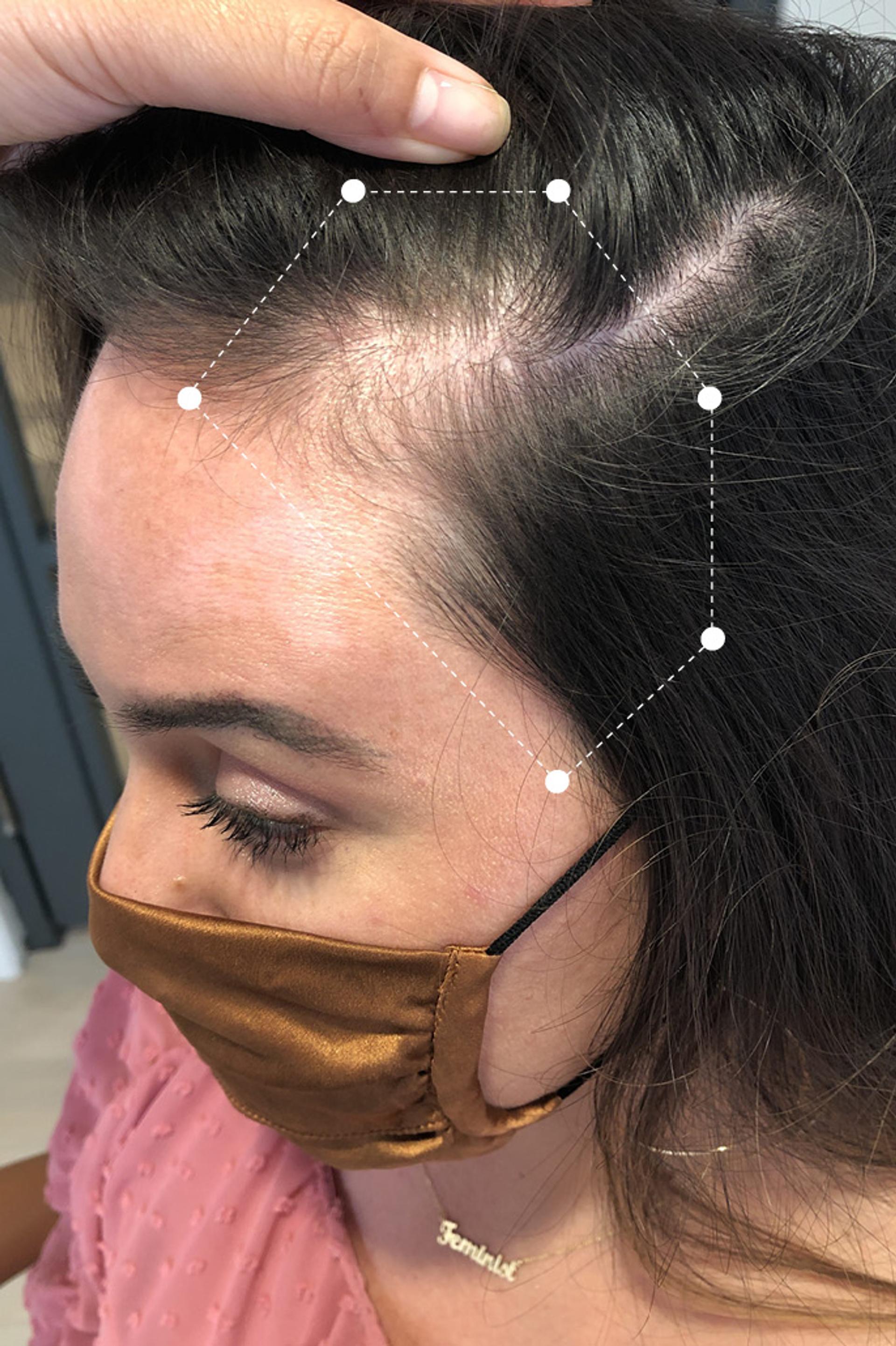 Side of head close up of dark haired woman's scalp before going on the Harklinikken Regimen