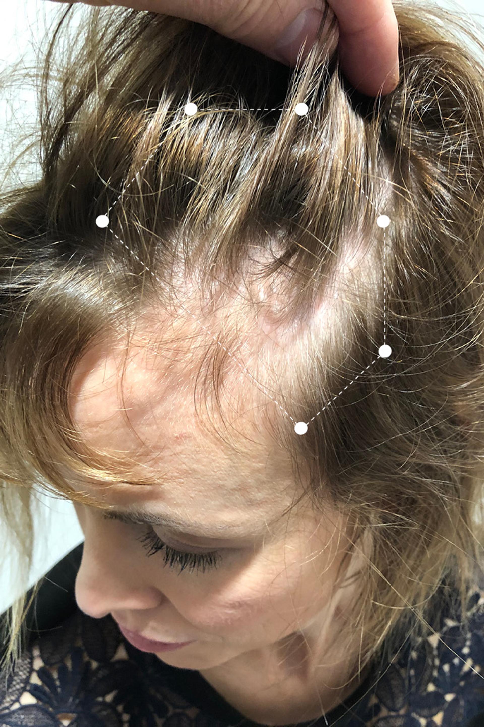 Side picture of hair thinning at the front of the scalp before the Harklinikken Regimen