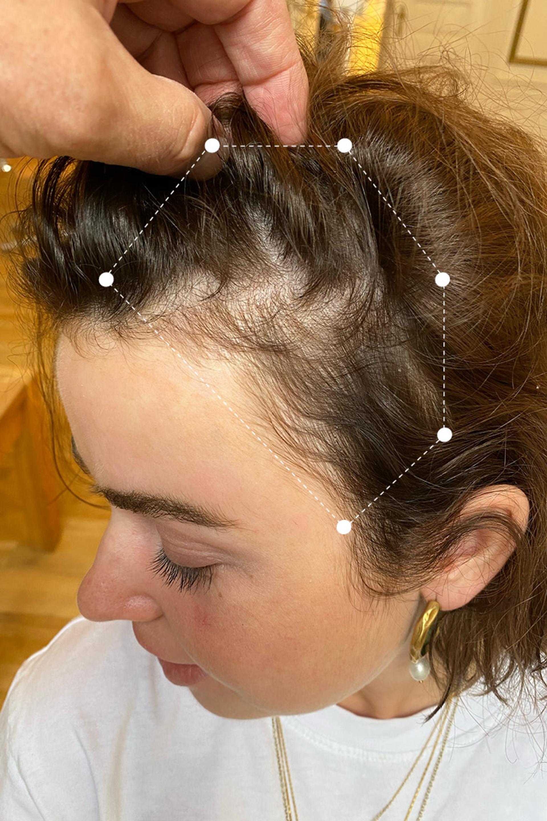 Side of head photo of brunette female scalp before 11 months on Harklinikken Regimen