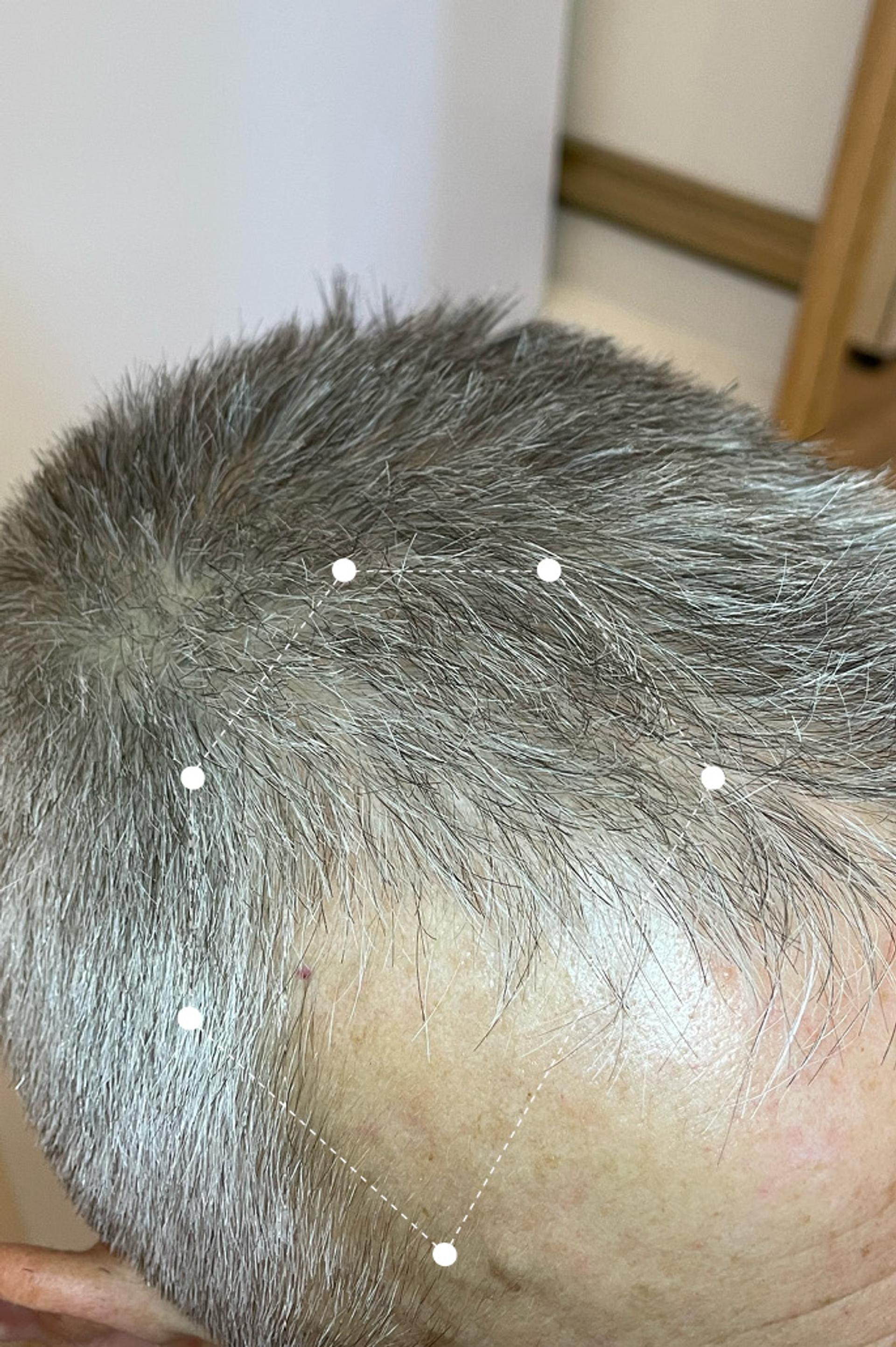 Picture of grey male's  side of scalp results after 3 months on extract