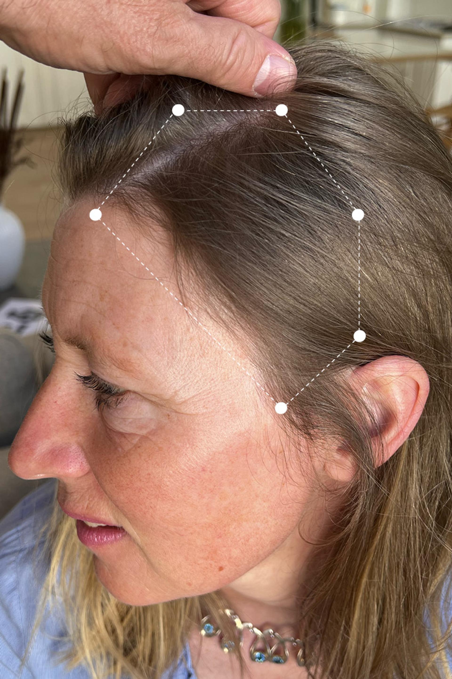 Picture of Hair Thinning around Temple Area on Dark Blonde Client After using the Harklinikken Hair Gain Extract