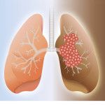 ACCC Recognizes Lung Cancer Awareness Month