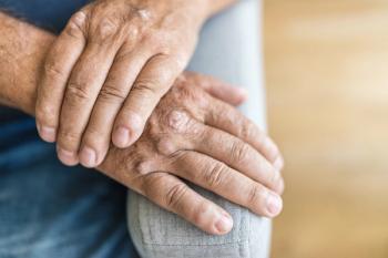 Credit: and.one | stock.adobe.com. Elderly man suffering from psoriasis on hands