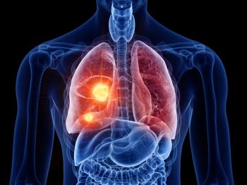 Image credit: SciePro | stock.adobe.com. 3d rendered illustration of lung cancer 3D illustration
