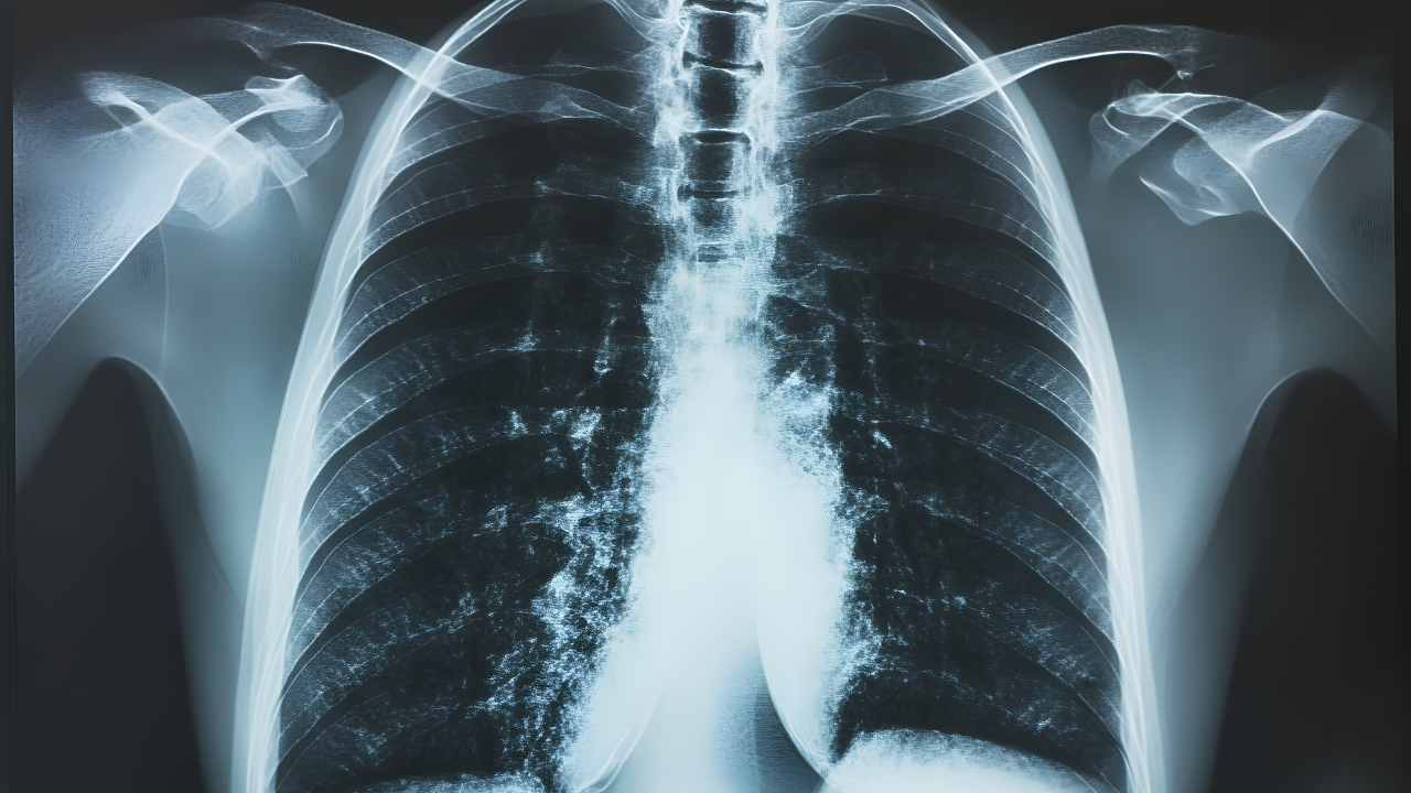 Phase II Trial Demonstrates Encouraging Anti-Tumor Activity in Non-Small Cell Lung Cancer with sac-TMT