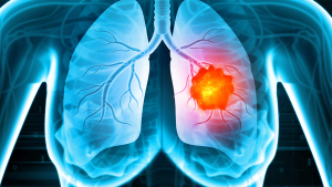 AstraZeneca’s Tagrisso Shows Landmark Overall Survival Benefit in Non-Small Cell Lung Cancer