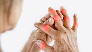 Atom Therapeutics Launches Global Phase II Trial of Novel Anti-Inflammatory Treatment for Acute Gout Flares