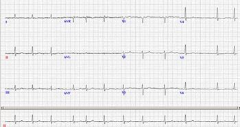 Afib figure 1.jpg