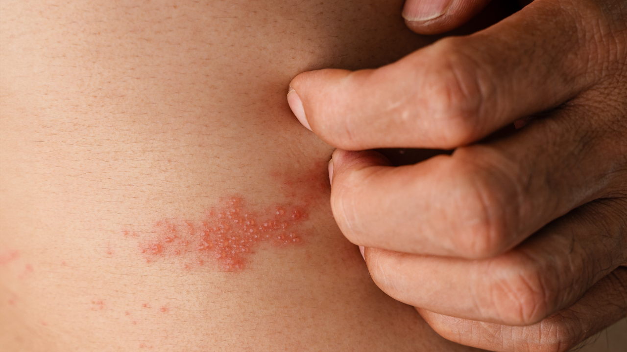 Dynavax Technologies’ Investigational Shingles Vaccine Achieves Complete Antibody Response in Phase I/II Shingles Trial