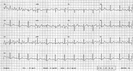 Afib Detection True Or False Due To Bad Quality Recordings