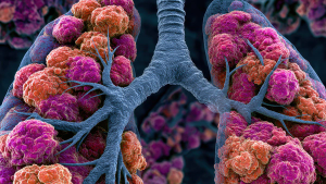 Investigational PD-L1 x VEGF-A Bispecific Antibody Demonstrates Strong Overall Response Rate in Phase II Small Cell Lung Cancer Trial