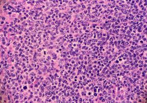 Image Credit: Adobe Stock Images/Lisa. High grade follicular lymphoma with marginal zone differentiation.