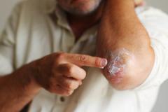 Man applying cream to rash | Image credit: Olga - stock.adobe.com
