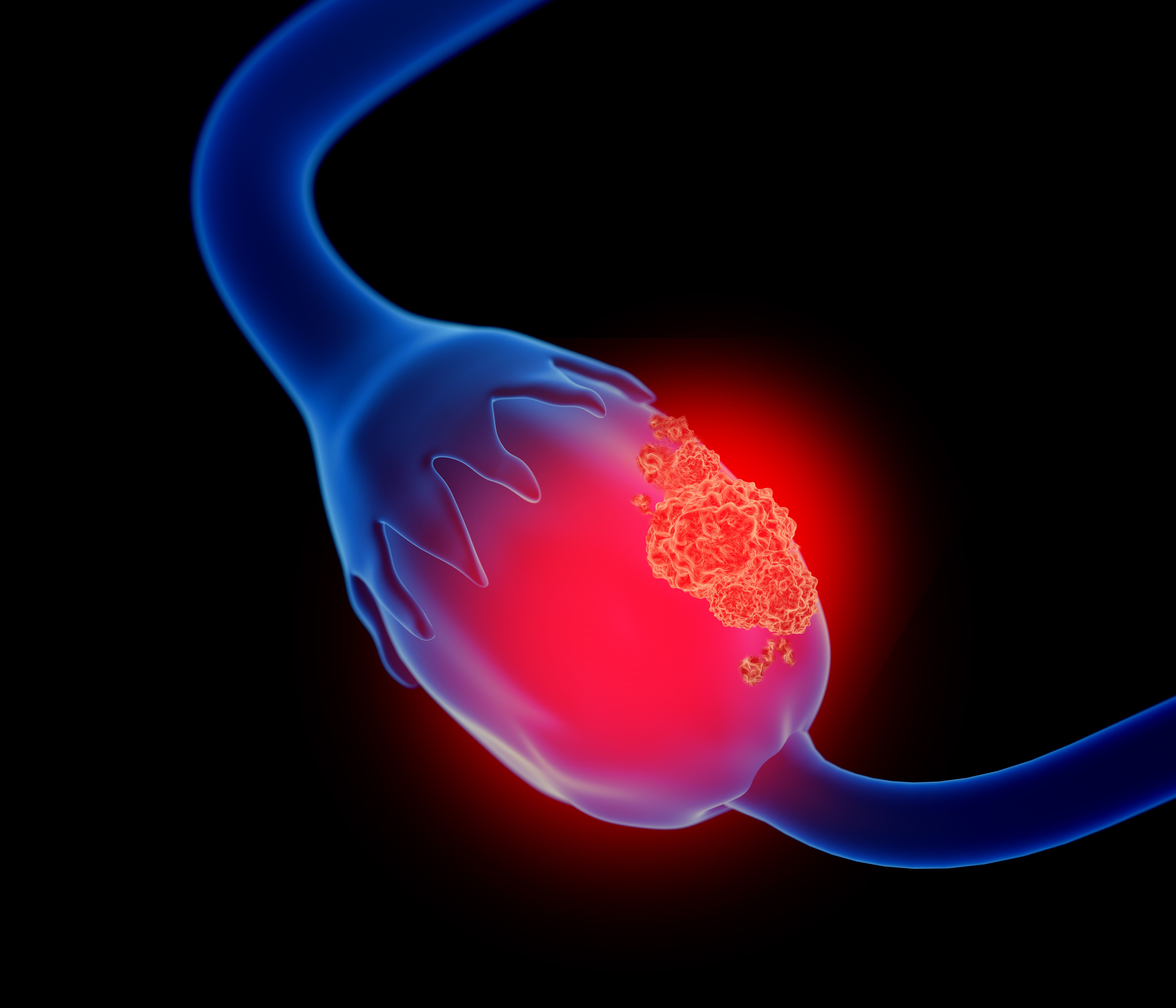 3D ovarian cancer illustration | Image Credit: Lars Neumann - stock.adobe.com