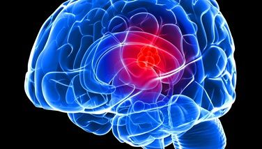 An Immune-Suppressing Target for Glioblastoma?