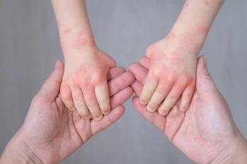 Child with atopic dermatitis (AD) | Image Credit: Юля Шевцова - stock.adobe.com