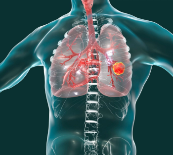 NSCLC | Image: Lung Cancer Foundation of America