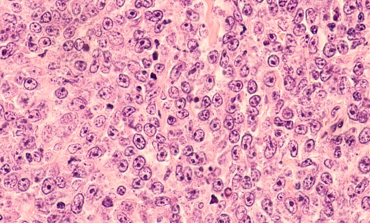 Photomicrograph of a diffuse large B-cell lymphoma | Image Credit: ©DavidALitman - stock.adobe.com