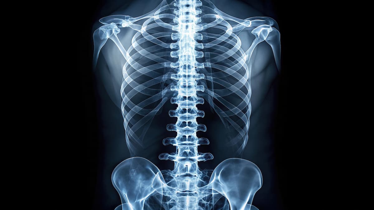 Vertebral fractures are common in glucocorticoid-associated osteoporosis and are a clinical indicator of osteoporosis in young patients. | Image credit: Hugnaka - stock.adobe.com