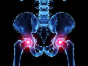 Researchers Struggle to Define Quality Indicators for Hip Fracture