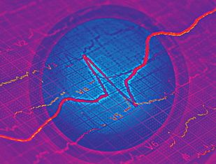 Late Onset of Migraine With Aura Linked to Ischemic Stroke